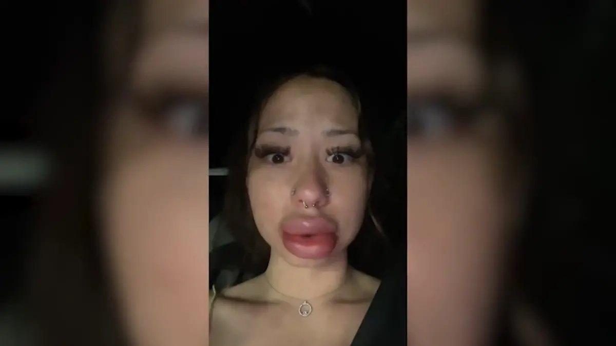 Dicke-Lippen-nach-dem-K-ssen-Ist-Andrea-Toldeo-gegen-ihren-eigenen-Freund-allergisch-