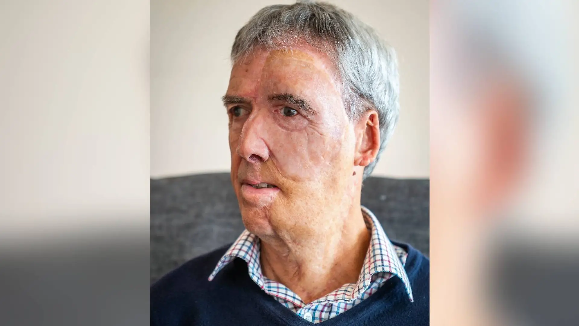 Dave Richards bekommt nach einem schweren Unfall im Rahmen seiner Behandlung eine 3D-Prothese für sein Gesicht. 