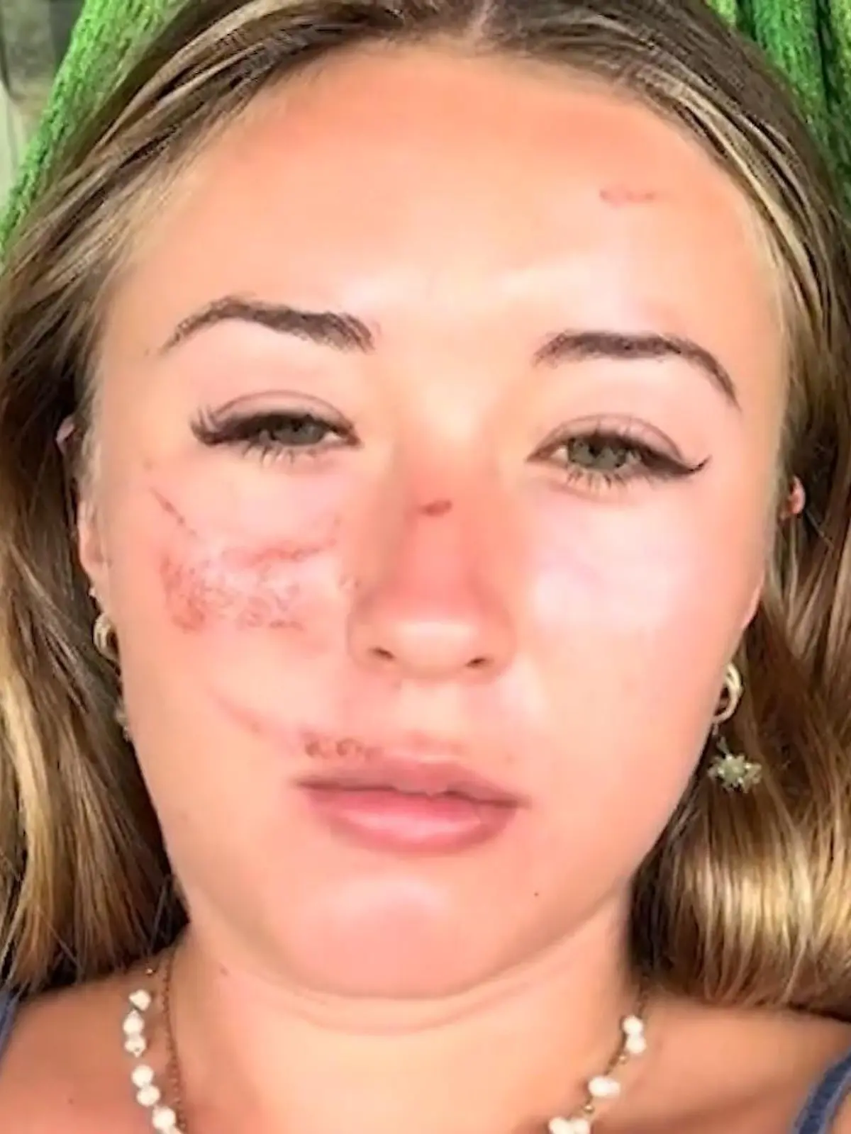 Bild zu: "Über Nacht! Vietnam-Touristin hat plötzlich merkwürdige Wunden am ganzen Körper"