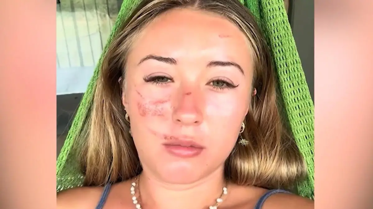 Vietnam-Touristin ist plötzlich übersät mit merkwürdigen Wunden Ursache hatte niemand im Kopf