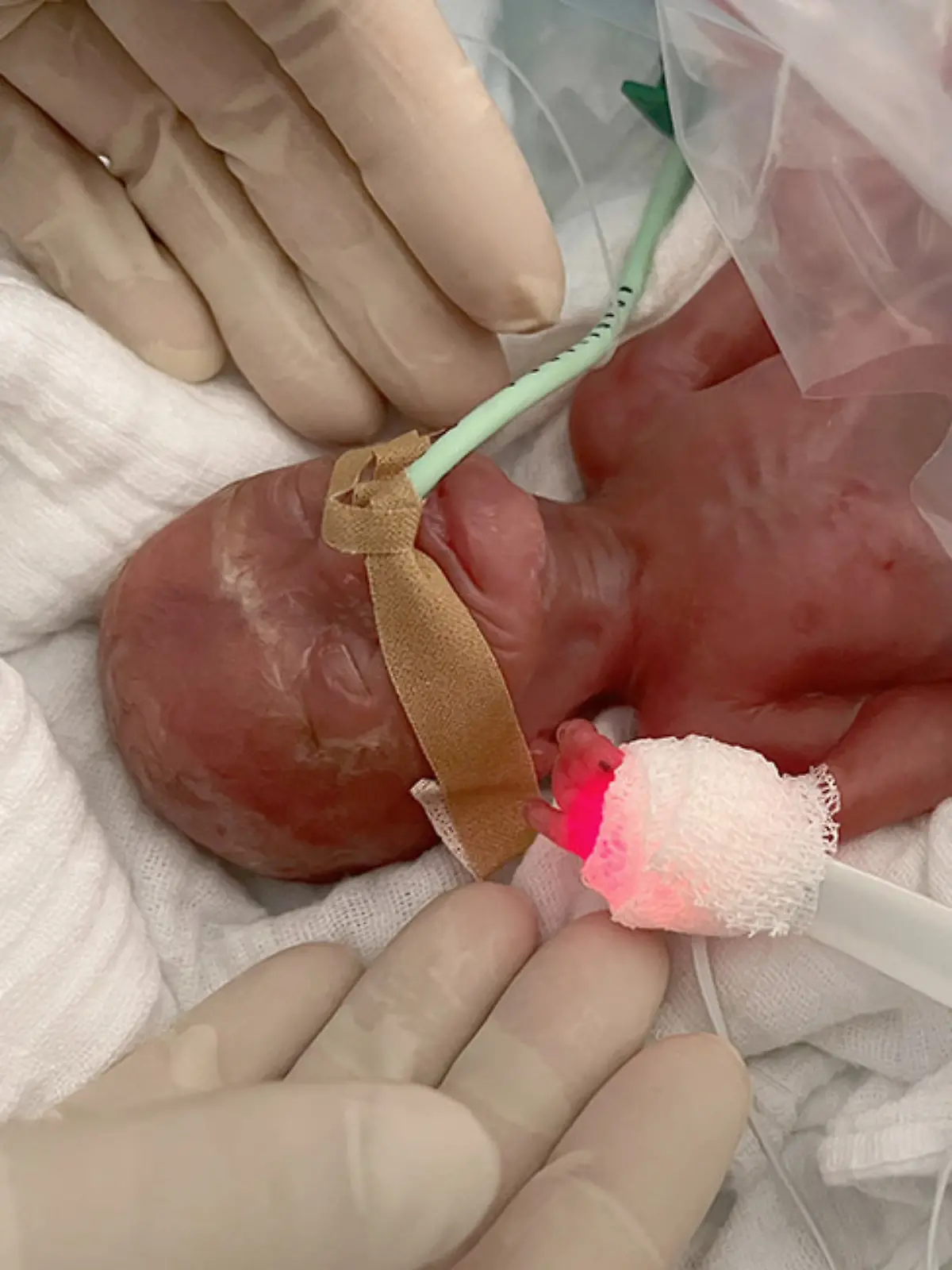 Universitätsklinikum Magdeburg - 300 Gramm Frühchen