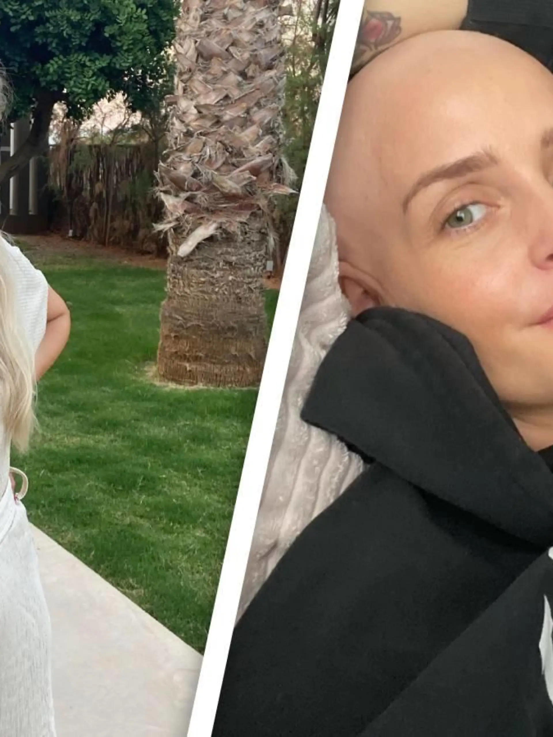 Veronique Kieffer hat Alopecia.