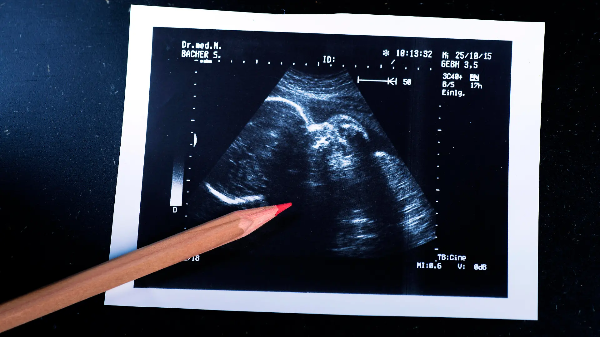Sonografie eines Embryo im Mutterleib, 09.04.2014.