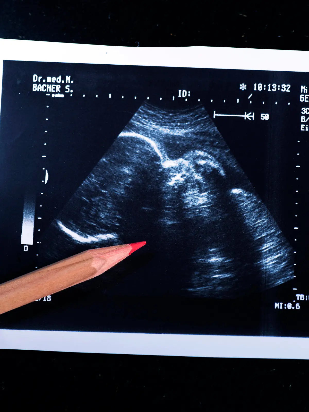 Sonografie eines Embryo im Mutterleib, 09.04.2014.