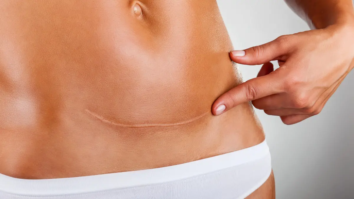 Closeup of woman belly with a scar from a cesarean section