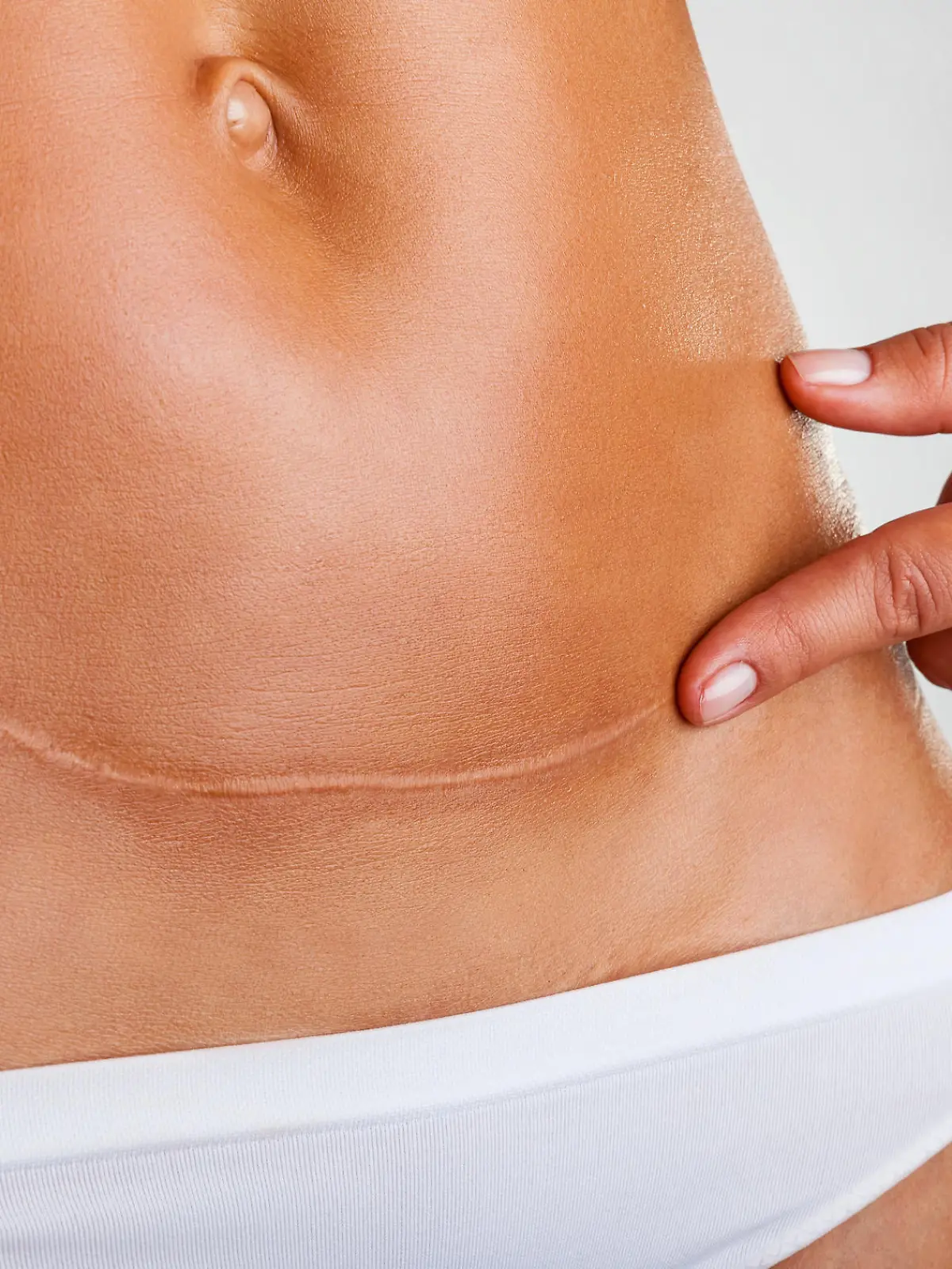 Closeup of woman belly with a scar from a cesarean section