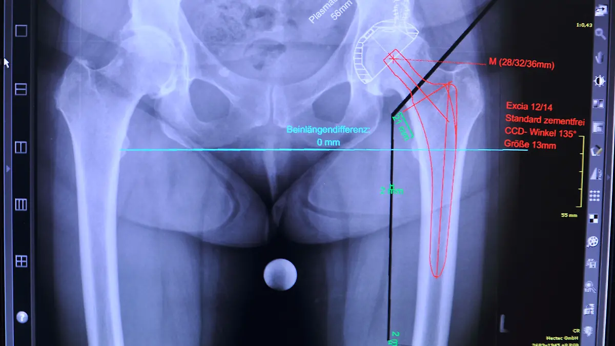 Das Einsetzen einer kuenstlichen Huefte  gehoert heute zum Standard guter Kliniken in den operativen Abteilungen, wie hier in der St. Vinzenz-Klinik im Sauerland.  Ein eingespieltes Team aus Orthopaeden , Unfallchirurgen und Aneastesisten  bewaelltigt diese Operation mit solidem Handwerk und aerztlicher Kunst zur Erleichterung und Verbesserung der Lebensqualitaet der Patienten.Foto: Klaus Rose