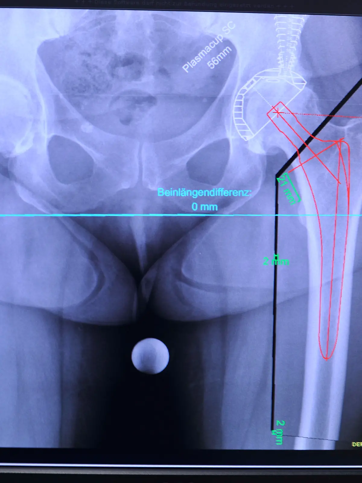 Das Einsetzen einer kuenstlichen Huefte  gehoert heute zum Standard guter Kliniken in den operativen Abteilungen, wie hier in der St. Vinzenz-Klinik im Sauerland.  Ein eingespieltes Team aus Orthopaeden , Unfallchirurgen und Aneastesisten  bewaelltigt diese Operation mit solidem Handwerk und aerztlicher Kunst zur Erleichterung und Verbesserung der Lebensqualitaet der Patienten.Foto: Klaus Rose