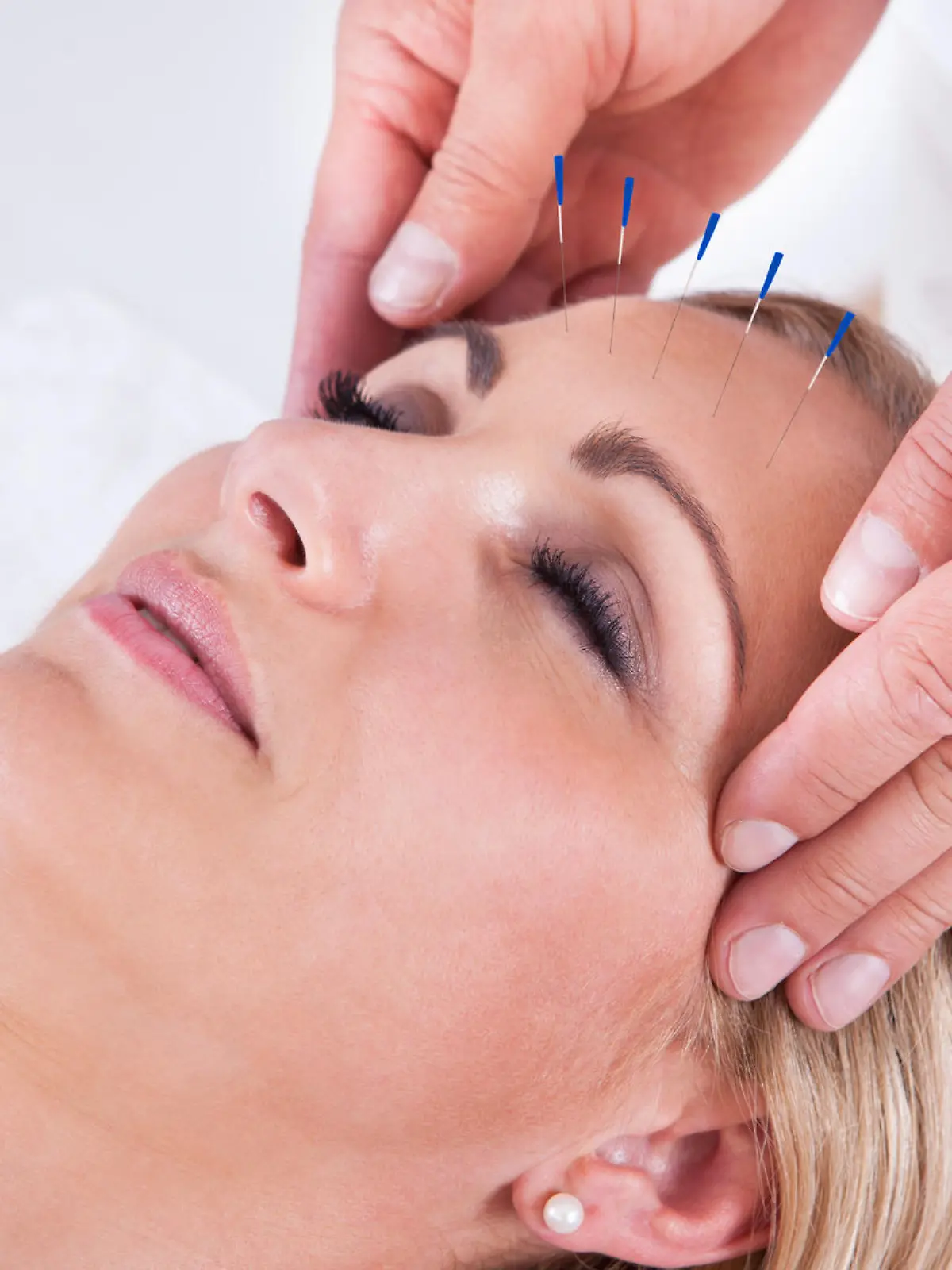 Detail Of A Woman  Receiving An Acupuncture Needle Therapy