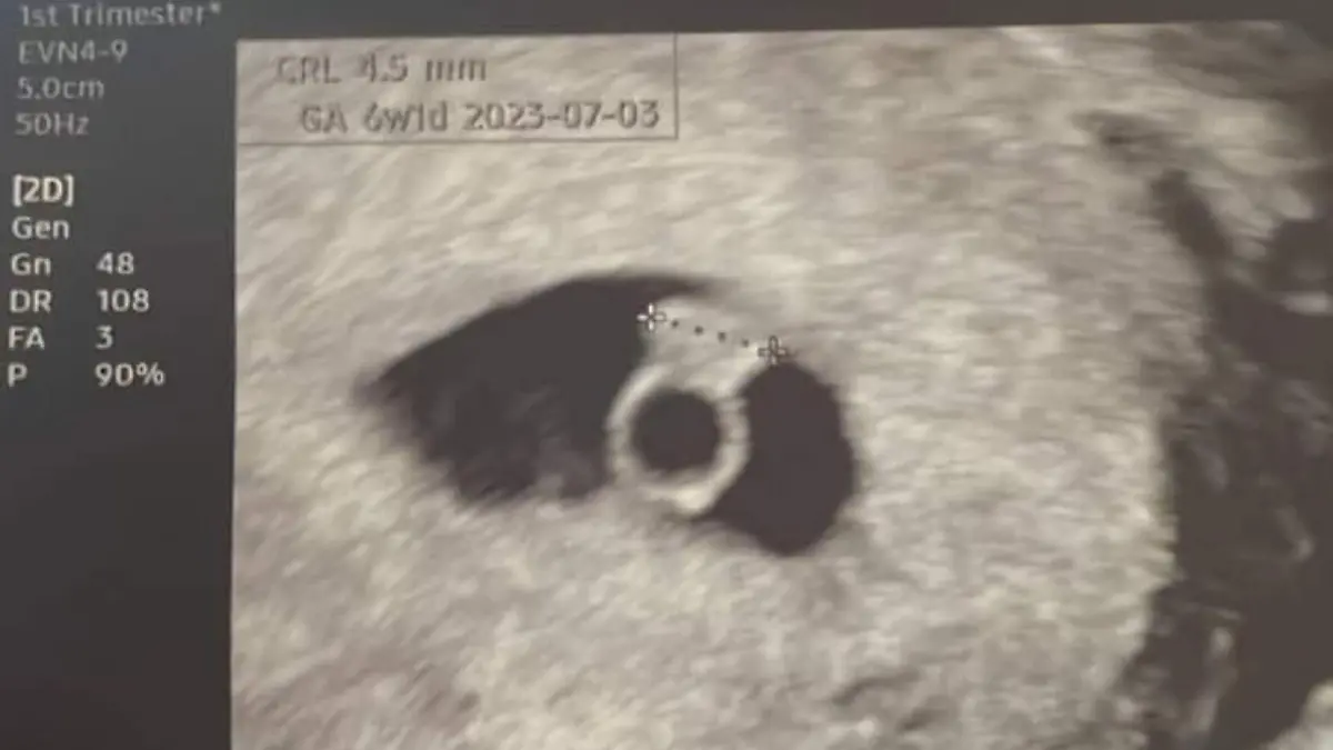 CATERS NEWS (PICTURED Adel Varga's embryo scan) A woman who was born with a rare condition that means she has two uteruses, two vaginas, and two cervixes has welcomed a miracle baby after years of trying. Adel Varga, 29, began suffering from painful periods when she was 14, but she didn't get a full diagnosis of her complicated condition, Herlyn-Werner-Wunderlich syndrome, until she was 28 years old. After seeing multiple doctors over a decade, Adel says was warned that she may never be able to have a baby. She met her husband, Balázs Pór, in March 2020, and began trying for a baby four months into their relationship. SEE CATERS COPY