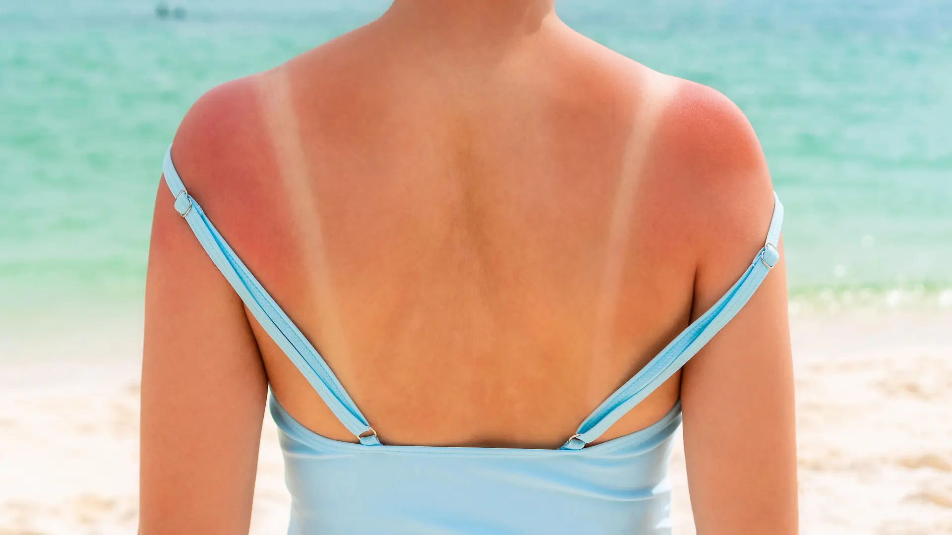 Sunburned skin on shoulder and back of a woman because of not using cream with sunscreen protection. Red skin sun burn after Sunbathing at the beach. Summer and holiday concept. Close up