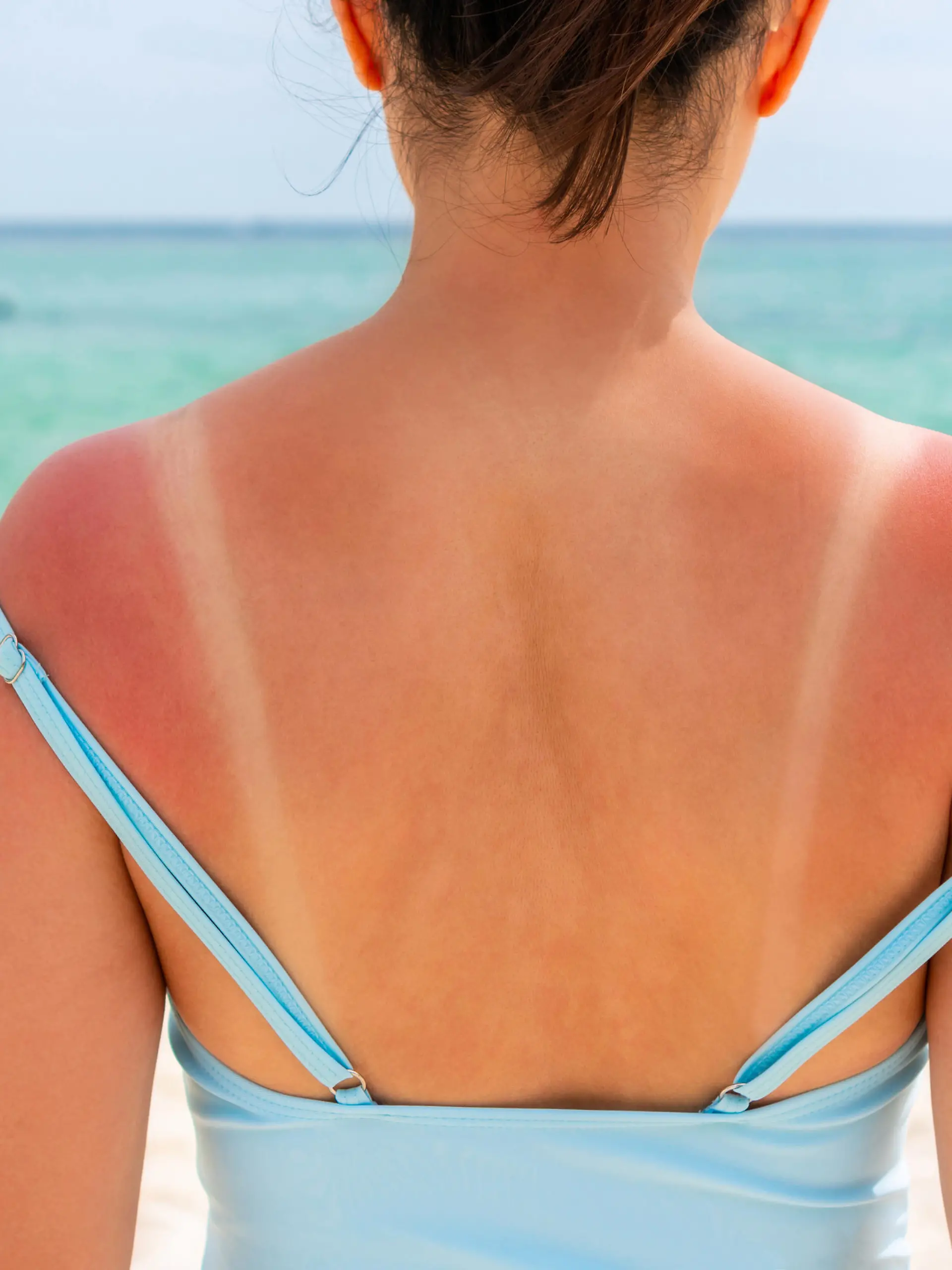 Sunburned skin on shoulder and back of a woman because of not using cream with sunscreen protection. Red skin sun burn after Sunbathing at the beach. Summer and holiday concept. Close up