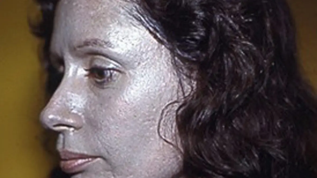 Pic By HotSpot Media - WOMAN'S SKIN TURNED SILVER AFTER TAKING NOSE DROPS -IN PIC - Rosemary Jacobs, shown here in 1978  aged 36 just before her face dermabrasion -An American woman whose skin turned silver after using nose drops is warning people of the dangers of medicines containing the metal. Rosemary Jacobs, 71, has lived with irreversible skin condition argyria for 60 years and it has blighted her life. The retired pre-school teacher's skin started to turn metallic silver when she began taking nasal drops containing colloidal silver (CS) at the age of 11. Four years later a skin biopsy revealed silver particles bound deep beneath her skin and she was diagnosed with argyria. Rosemary, from Vermont, USA said: “When I was 11 years old, my mother mentioned to an ENT specialist that I always had a cold. ……SEE HOTSPOT COPY 0121 551 1004