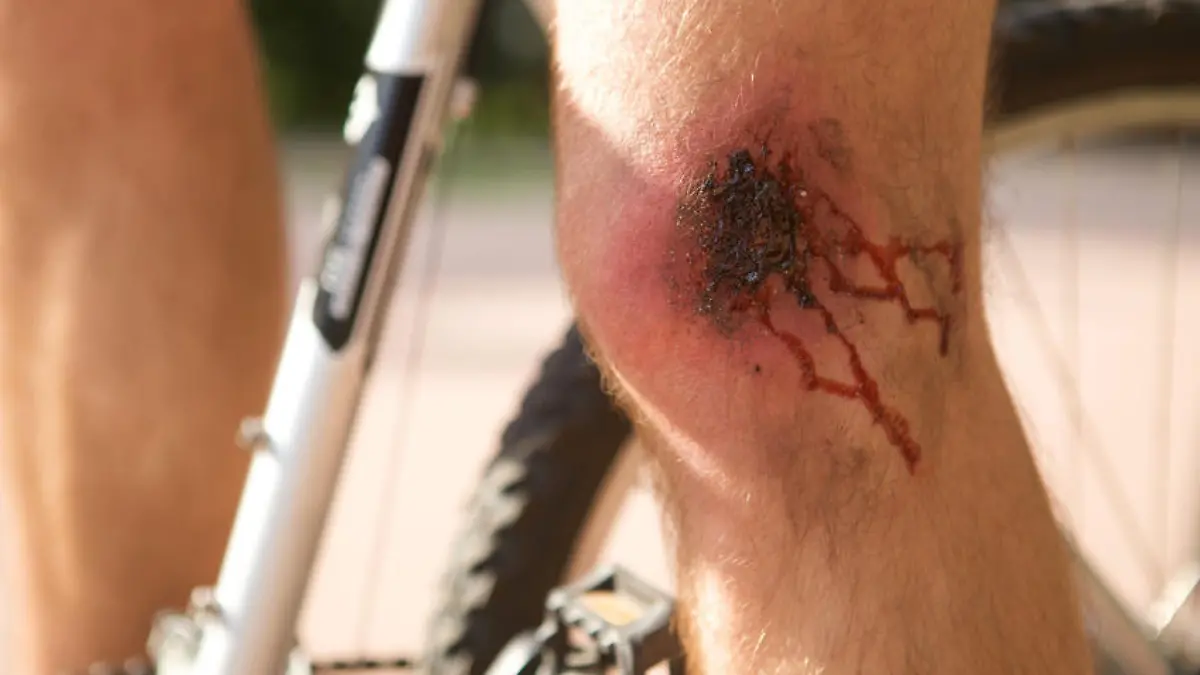 Man with a wound on his knee