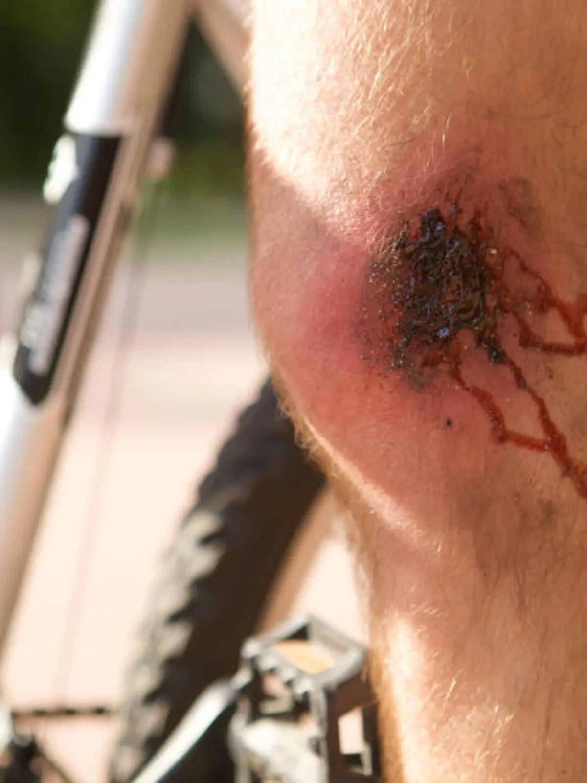 Man with a wound on his knee