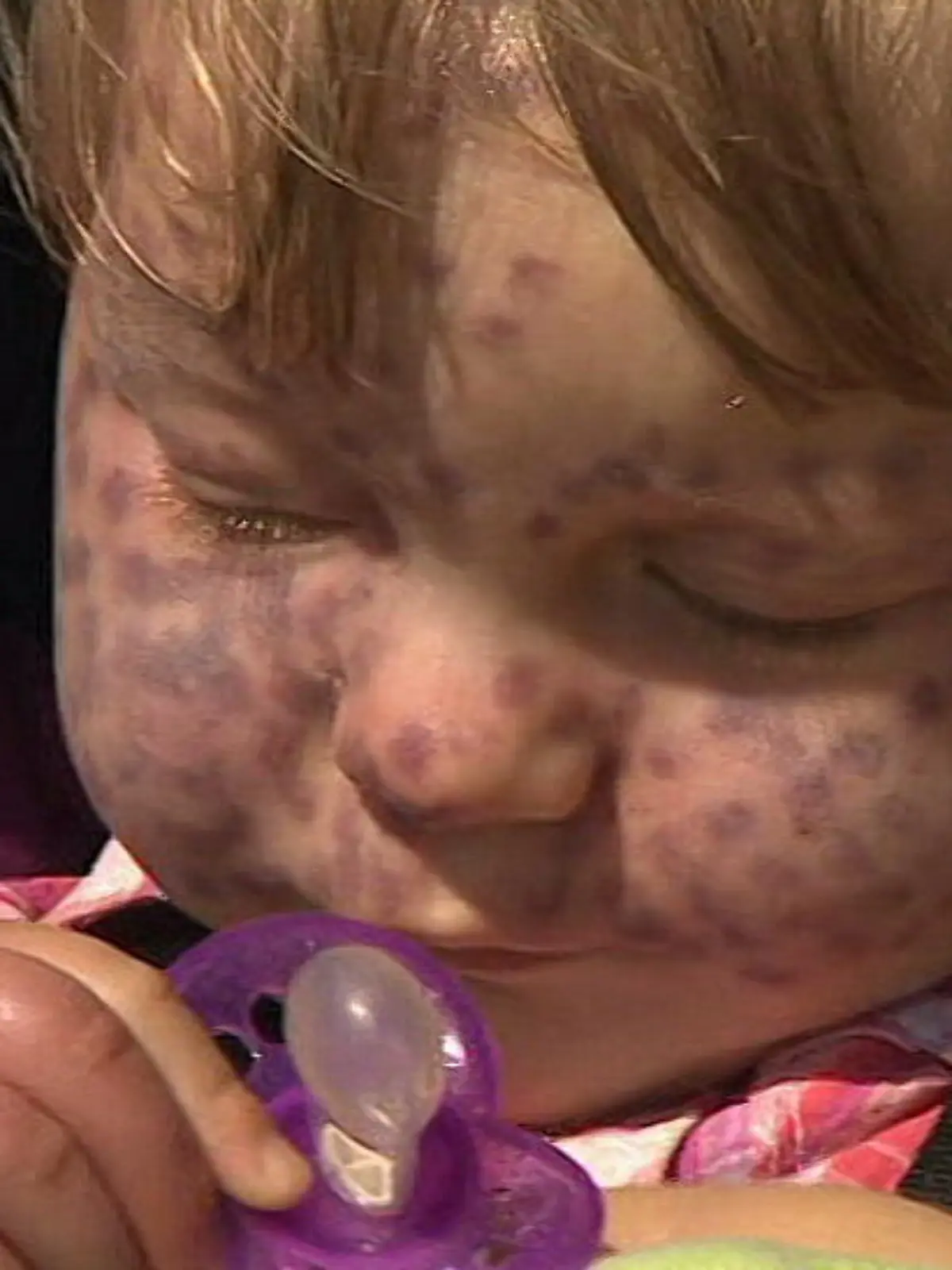 Sturge-Weber-Syndrom: Matilda (3) hat rote Punkte im Gesicht