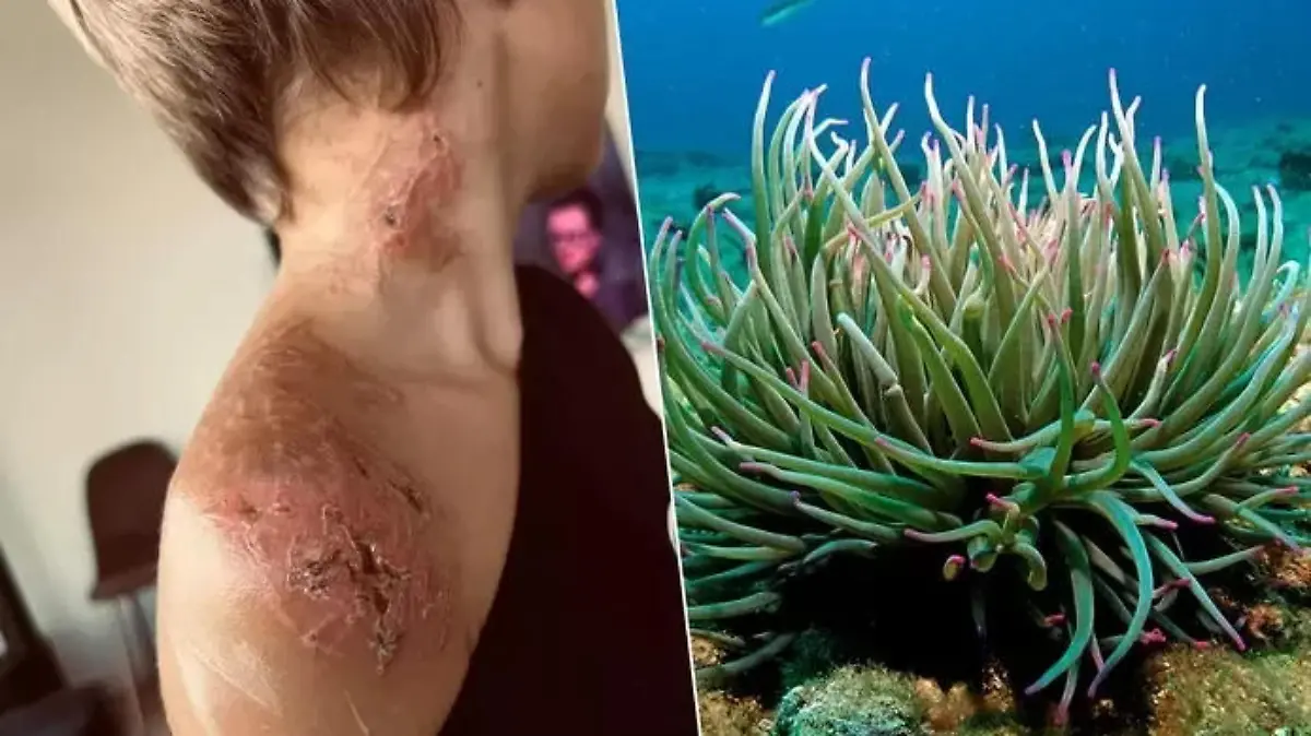 Junger Belgier in Frankreich von Seeanemone verletzt