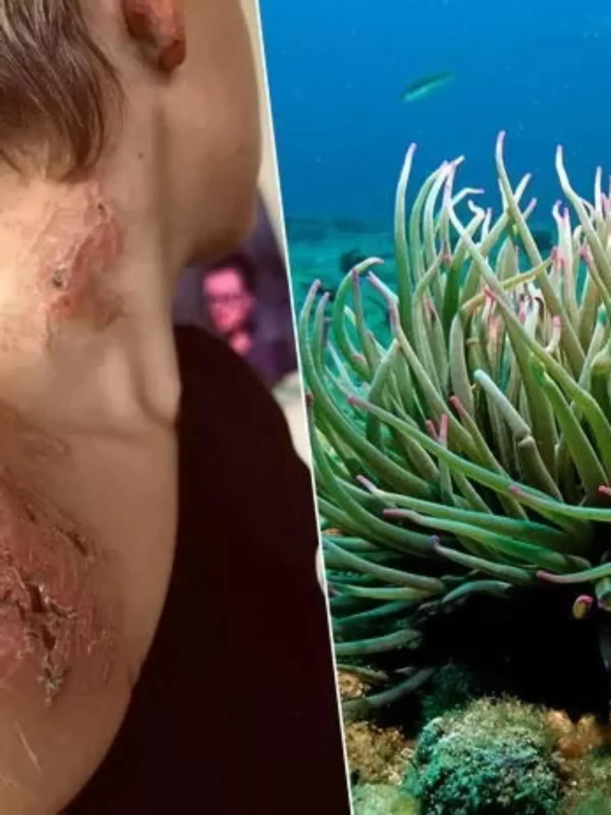 Junger Belgier in Frankreich von Seeanemone verletzt