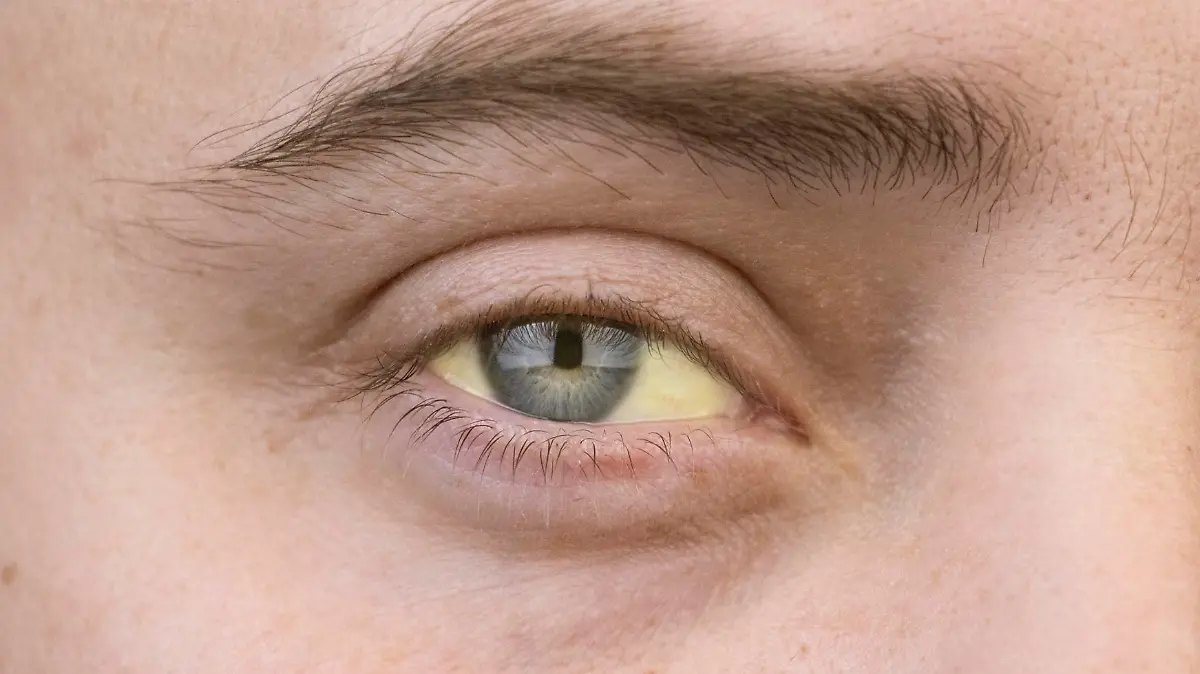 Gelb verfärbte Augen deuten auf eine Lebererkrankung hin.