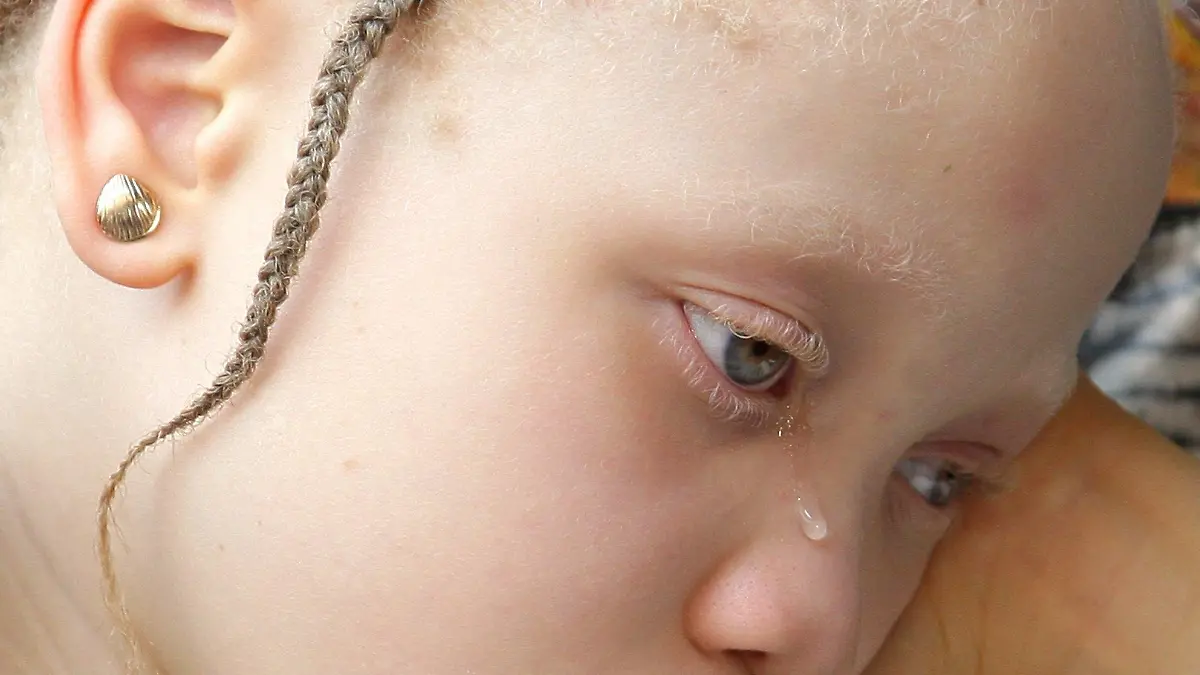 ARCHIV - Mit Tränen in den Augen - ein Albinokind in Abuja, Nigeria (Archivfoto vom 10.11.2008). Tausende Albinos sind in Ostafrika ständig auf der Flucht - wegen ihrer weißen Haut müssen sie fürchten, Opfer eines Ritualmords zu werden. Nach einem vor allem in Tansania verbreiteten Aberglauben besitzt das Blut der Albinos magische Kräfte. Viele der Menschen mit Pigmentstörung versteckten sich in ihren Häusern und wagten nicht mehr, am öffentlichen Leben teilzunehmen, teilte der Internationale Bund von Rotem Kreuz und Rotem Halbmond am Donnerstag (19.11.2009) mit. Foto: Wolfgang Kumm (zu dpa 0478 vom 19.11.2009) +++(c) dpa - Bildfunk+++