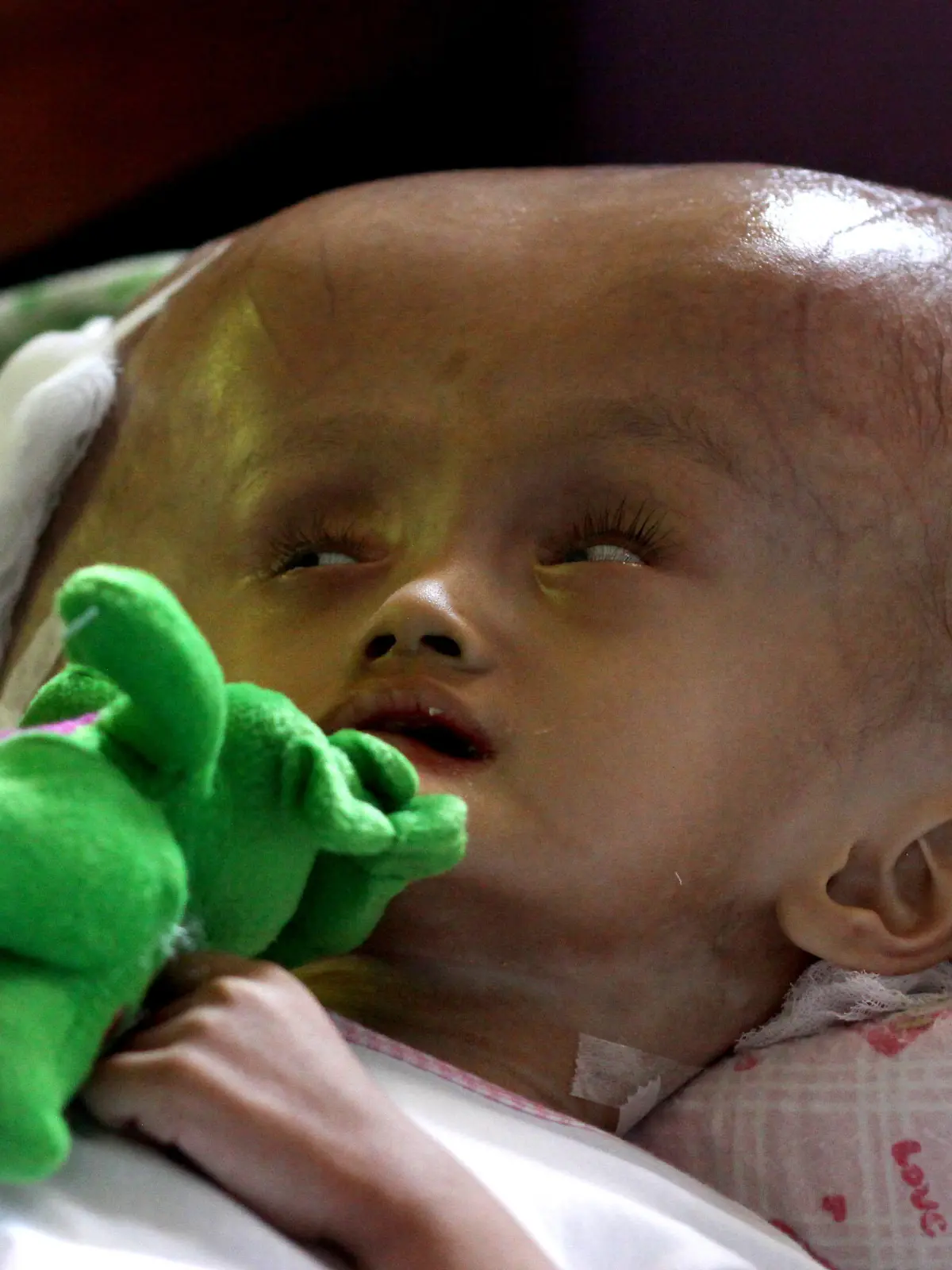 PIC BY JEFRI TARIGAN / CATERS NEWS - (Pictured Dilla Anargia Adilla) These are the heart-wrenching images of a toddler who suffers from a rare disease which has caused her head to grow to three times the size of an average adults. Little Dilla Anargia Adilla, 3, was born with Hydrocephalus a rare condition that causes her body to produce too much spinal fluid. This excess fluid collects in the skull causing her head to grow at an alarming rate and from ear to ear her head now measures a whopping 100cm. The debilitating condition has left the brave tot unable to walk or talk and she spends her days being cared for by her dad Azwar Anas, 31 and mum Puspita, 28 at their home in Bogor, Indonesia. The condition affects 1 in 500 babies and is treatable in the UK through a standard two-hour procedure, where a neurosurgeon inserts a thin tube called a shunt to drain the fluid. SEE CATERS COPY.
