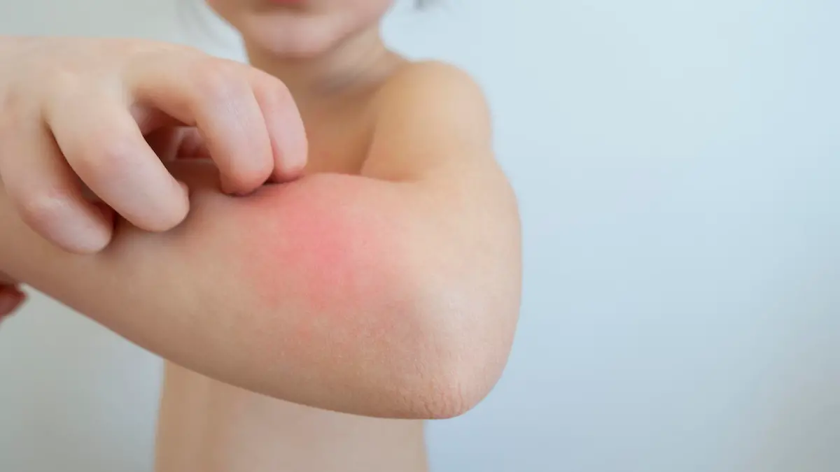 geschwollener Mückenstich