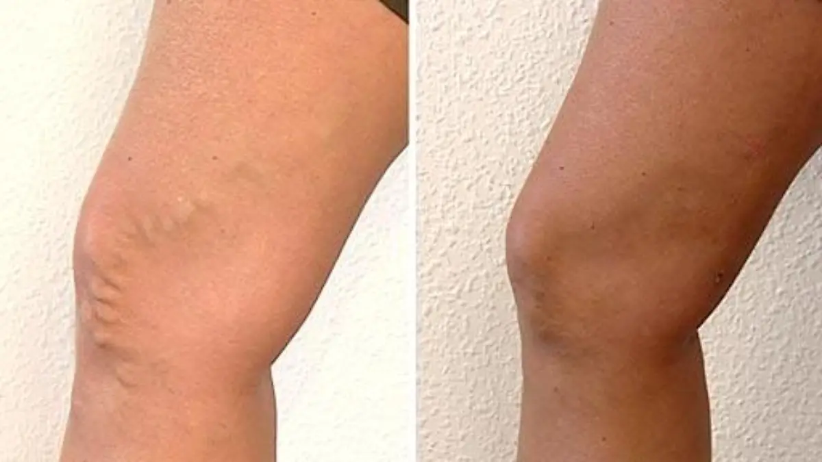 vvfz b 20090420 73566 512x288