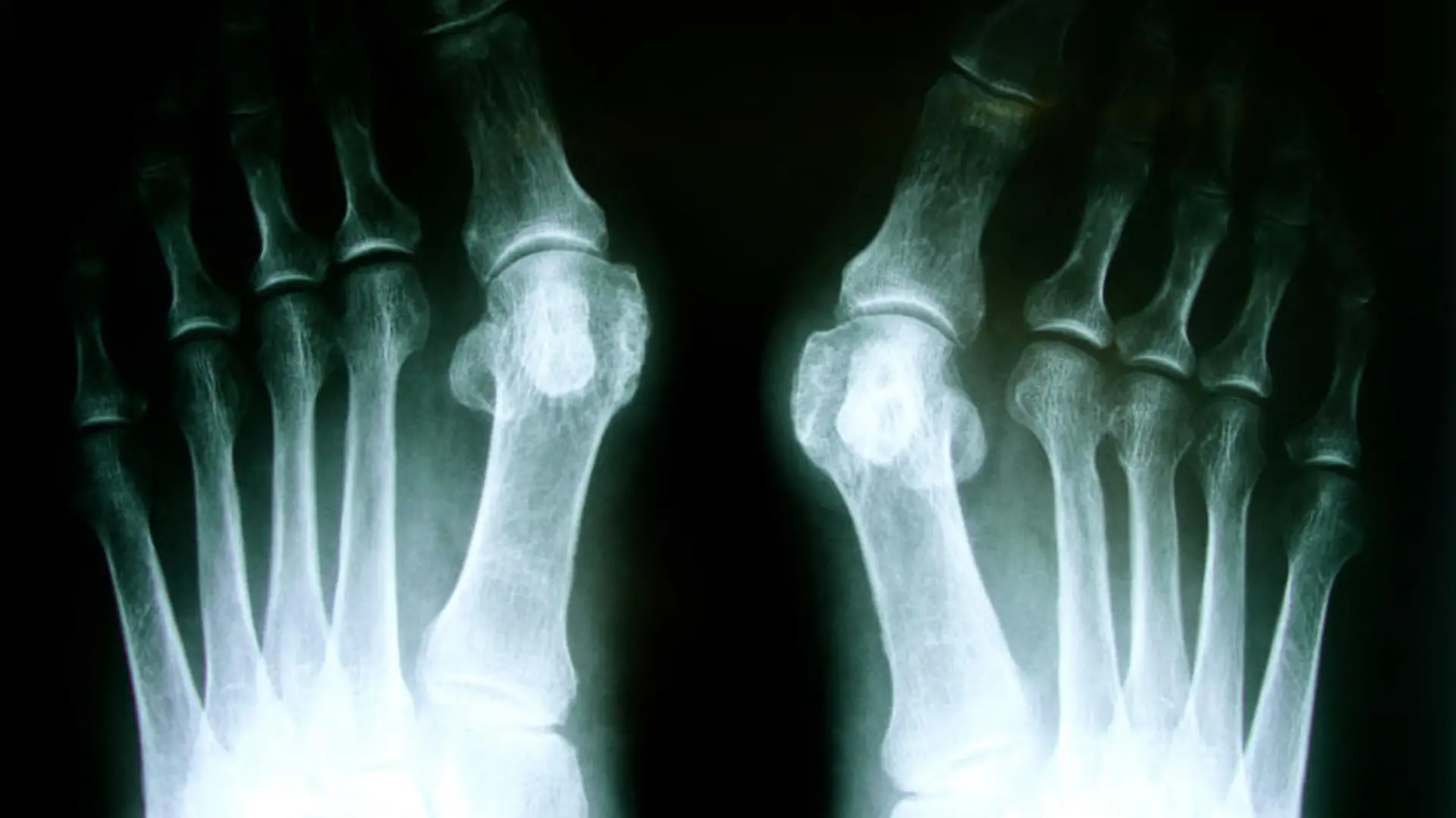hammerzeh hallux vallgus Fotolia 36571117 S.jpg