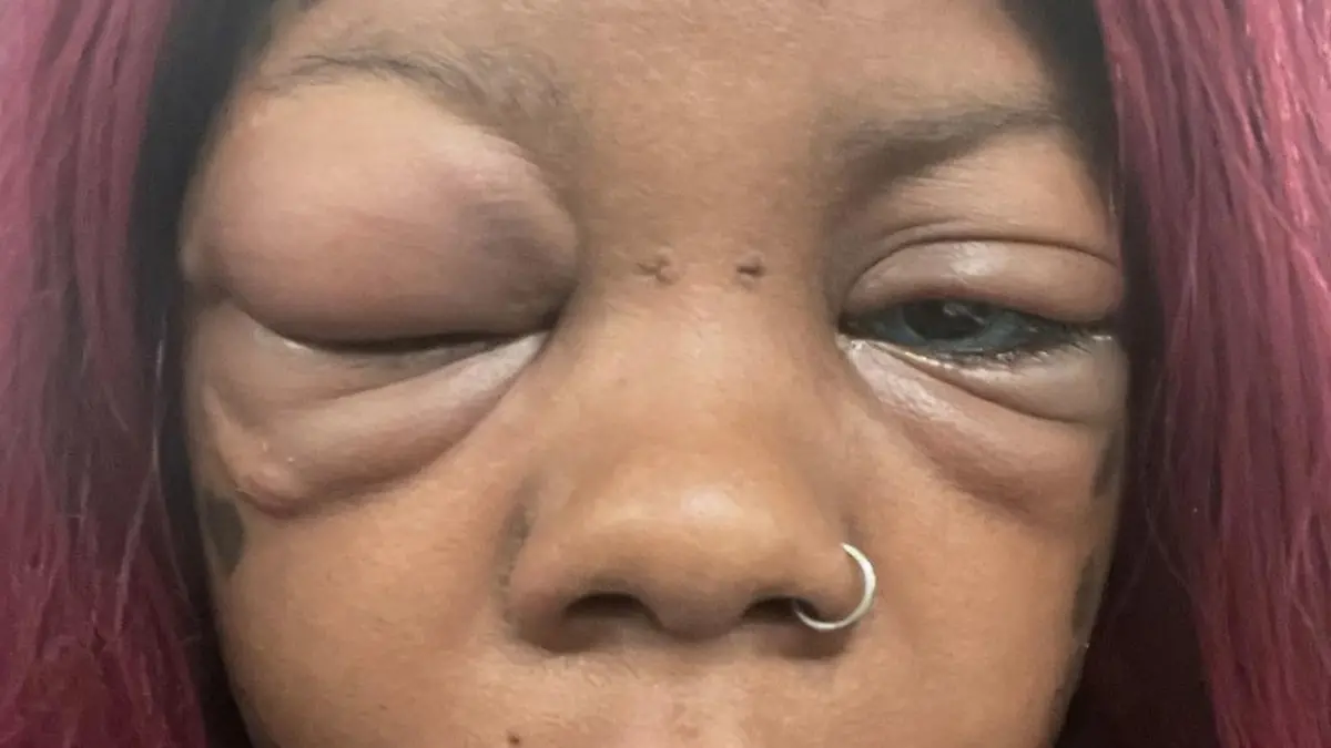 PIC FROM Kennedy News/inkedup_britishjamaican1 (PICTURED: ANAYA PETERSON, 32, WITH INFLAMED AND SWOLLEN EYES) A law student admits she regrets not listening to her seven-year-old daughter's warning she could go blind if she got her EYEBALLS tattooed - as she's now losing her sight. Mum-of-five Anaya Peterson was inspired by 'blue-eyed dragon' Amber Luke, an Aussie model who went blind for three weeks after dyeing her eyeballs blue in 2019. Unfortunately, 32-year-old Anaya, from Belfast, Ireland, was unluckier as the eye alteration left her hospitalised and facing permanent blindness. DISCLAIMER: While Kennedy News and Media uses its best endeavours to establish the copyright and authenticity of all pictures supplied, it accepts no liability for any damage, loss or legal action caused by the use of images supplied and the publication of images is solely at your discretion. SEE KENNEDY NEWS COPY - 0161 697 4266