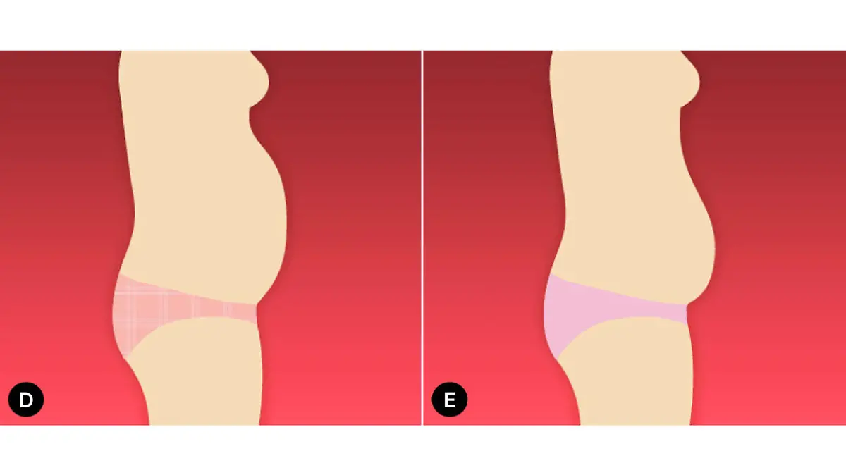 Bauch-Typen bei Frauen: der Stress-Bauch und der Blähbauch