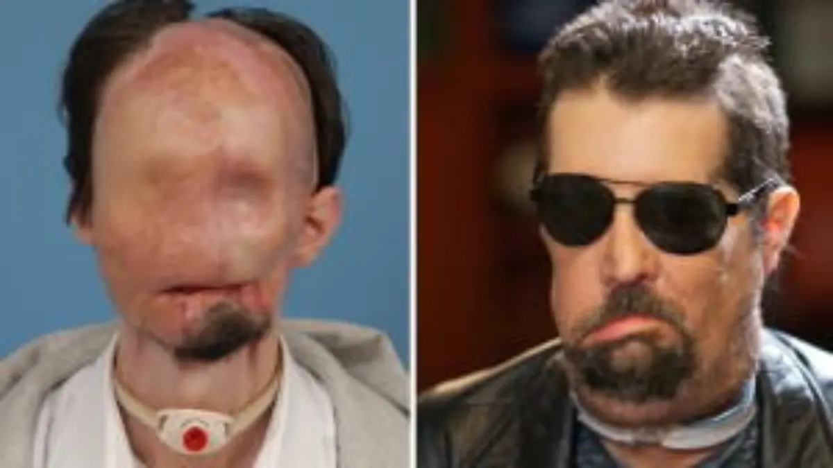 Nach einem Arbeitsunfall war Dallas Wiens entstellt. Nun haben ihm Ärzte ein komplettes Gesicht transplantiert.