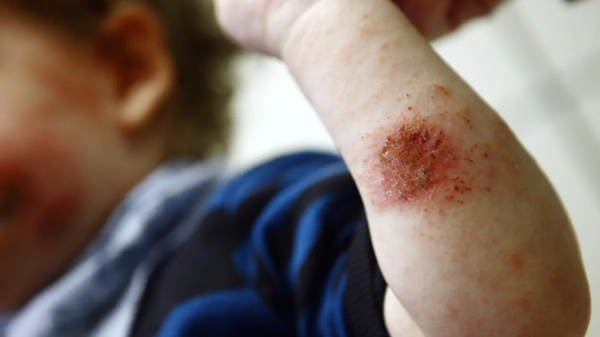 Ein Kind zeigt am Donnerstag (22.10.2009) in der Kinderklinik in Köln seine mit Neurodermitis befallenen Körperpartien. Fast 20 Jahre nach ihrer Entwicklung kommt Mitte November 2009 eine neue Salbe gegen die weit verbreitete Hautkrankheit Neurodermitis auf den Markt. Die in drei Studien klinisch getestete Salbe sei ohne Cortison weitgehend nebenwirkungsfrei, sagte eine Sprecherin der Herstellerfirma Regeneratio Pharma (Remscheid) der dpa. Foto: Oliver Berg dpa/lnw (zu dpa 0800) +++(c) dpa - Bildfunk+++