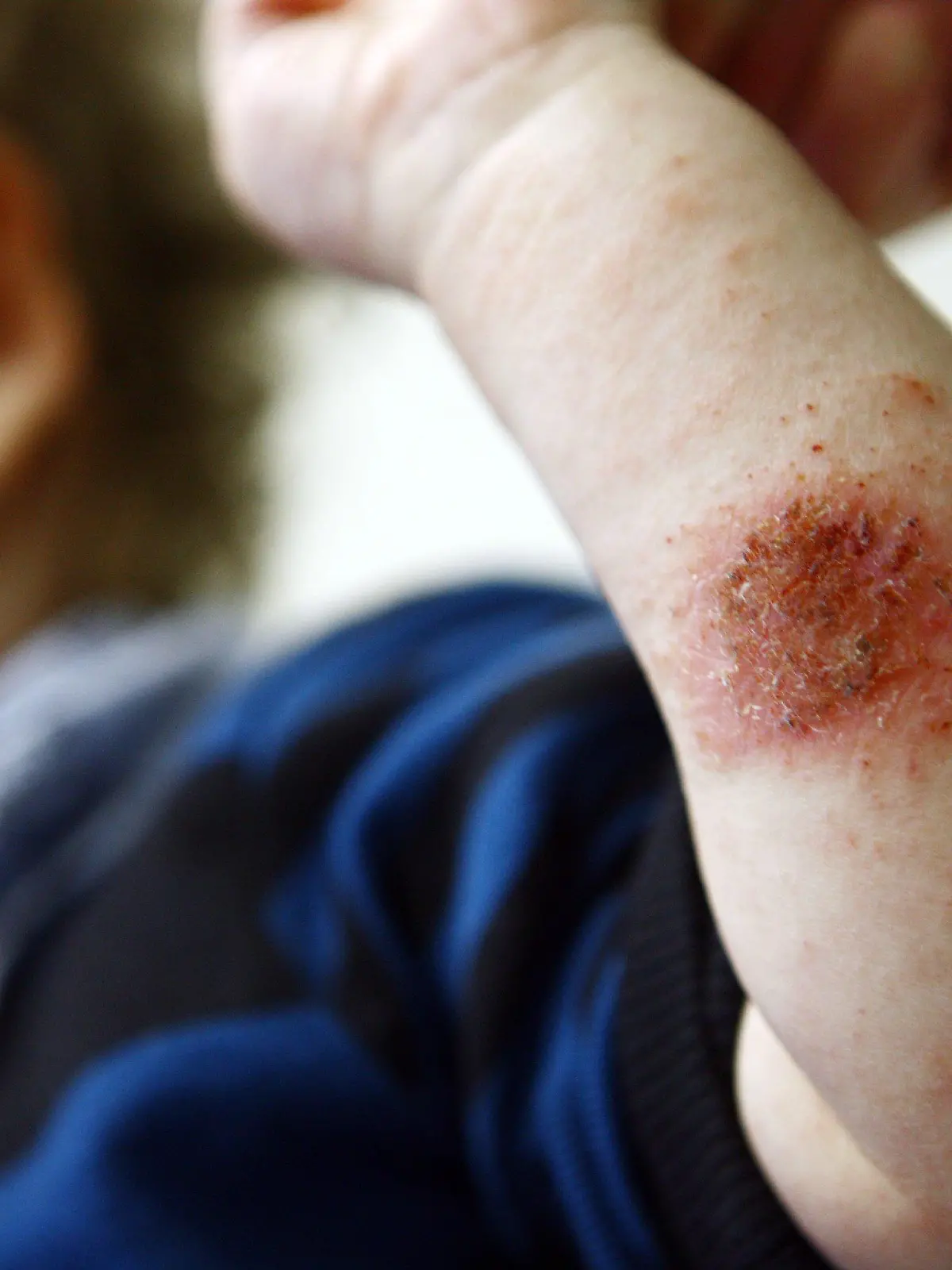 Ein Kind zeigt am Donnerstag (22.10.2009) in der Kinderklinik in Köln seine mit Neurodermitis befallenen Körperpartien. Fast 20 Jahre nach ihrer Entwicklung kommt Mitte November 2009 eine neue Salbe gegen die weit verbreitete Hautkrankheit Neurodermitis auf den Markt. Die in drei Studien klinisch getestete Salbe sei ohne Cortison weitgehend nebenwirkungsfrei, sagte eine Sprecherin der Herstellerfirma Regeneratio Pharma (Remscheid) der dpa. Foto: Oliver Berg dpa/lnw (zu dpa 0800) +++(c) dpa - Bildfunk+++
