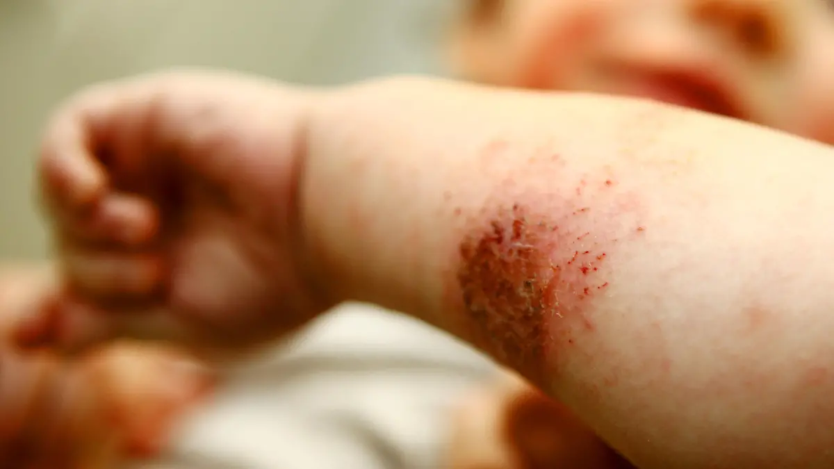 Ein Kind zeigt am Donnerstag (22.10.2009) in der Kinderklinik in Köln seine mit Neurodermitis befallenen Körperpartien. Fast 20 Jahre nach ihrer Entwicklung kommt Mitte November 2009 eine neue Salbe gegen die weit verbreitete Hautkrankheit auf den Markt. Die in drei Studien klinisch getestete Salbe sei ohne Cortison weitgehend nebenwirkungsfrei, sagte eine Sprecherin der Herstellerfirma Regeneratio Pharma (Remscheid) der dpa. Foto: Oliver Berg dpa/lnw (zu dpa 0800) +++(c) dpa - Bildfunk+++