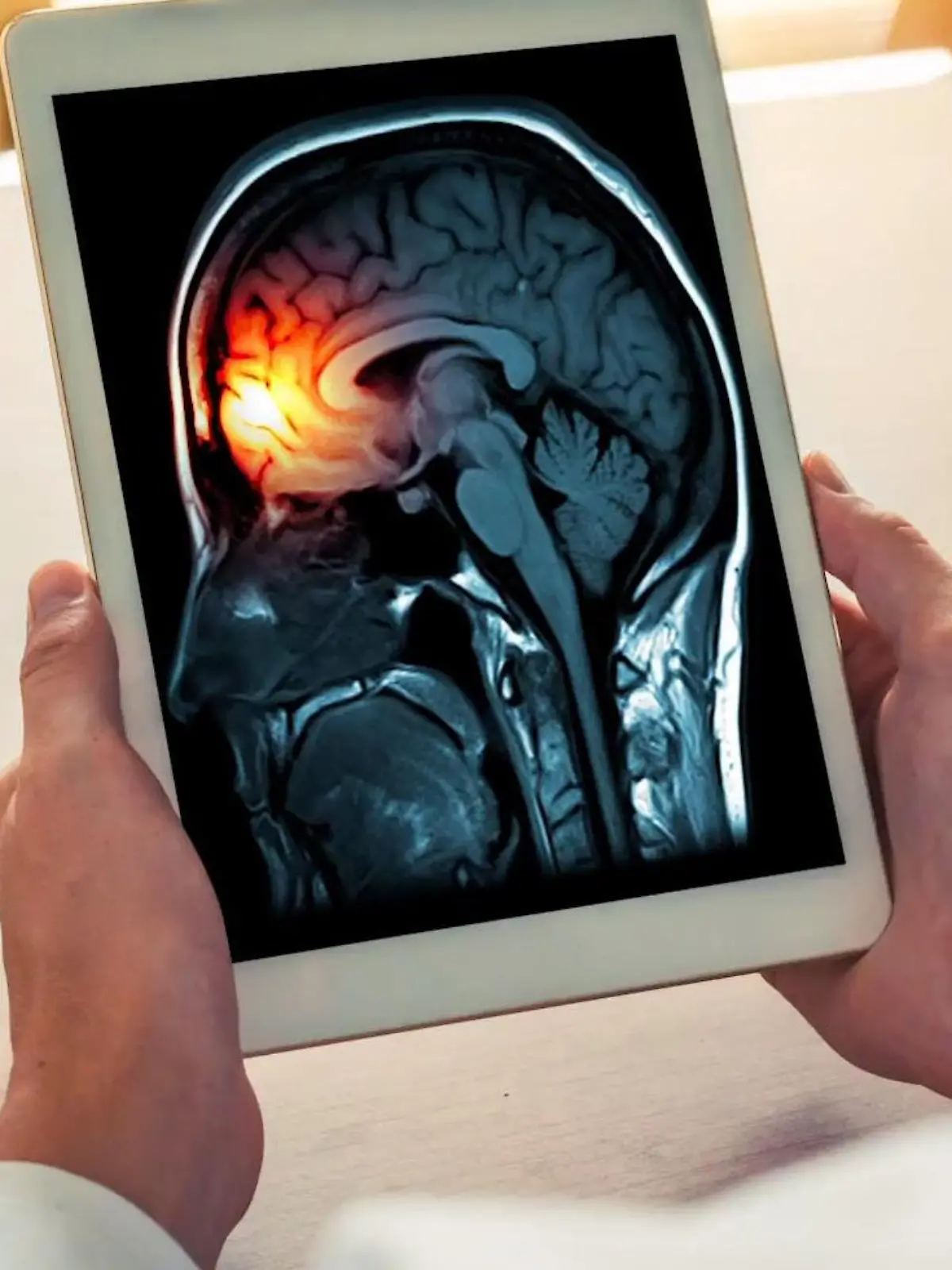 Bild zu: "Hirnhautentzündung (Meningitis)"