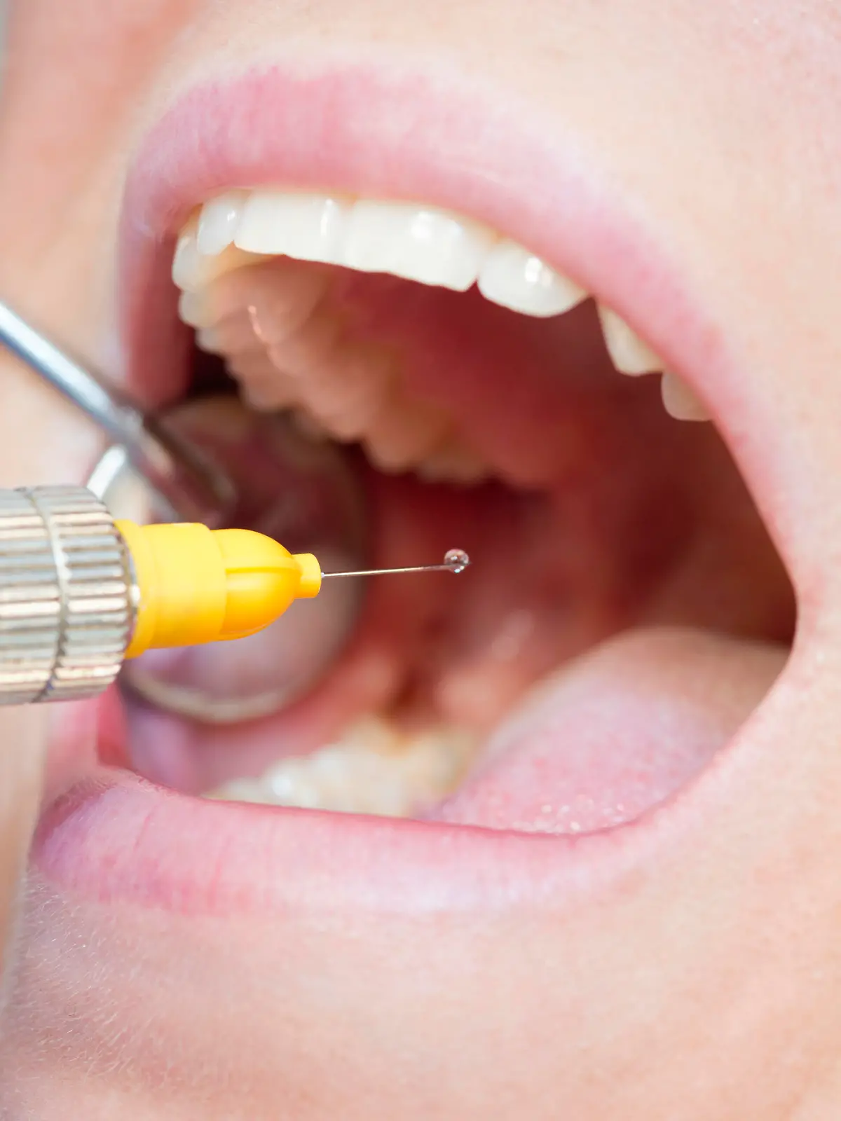 "Dental anesthetic. Close-up, focus on syringe"