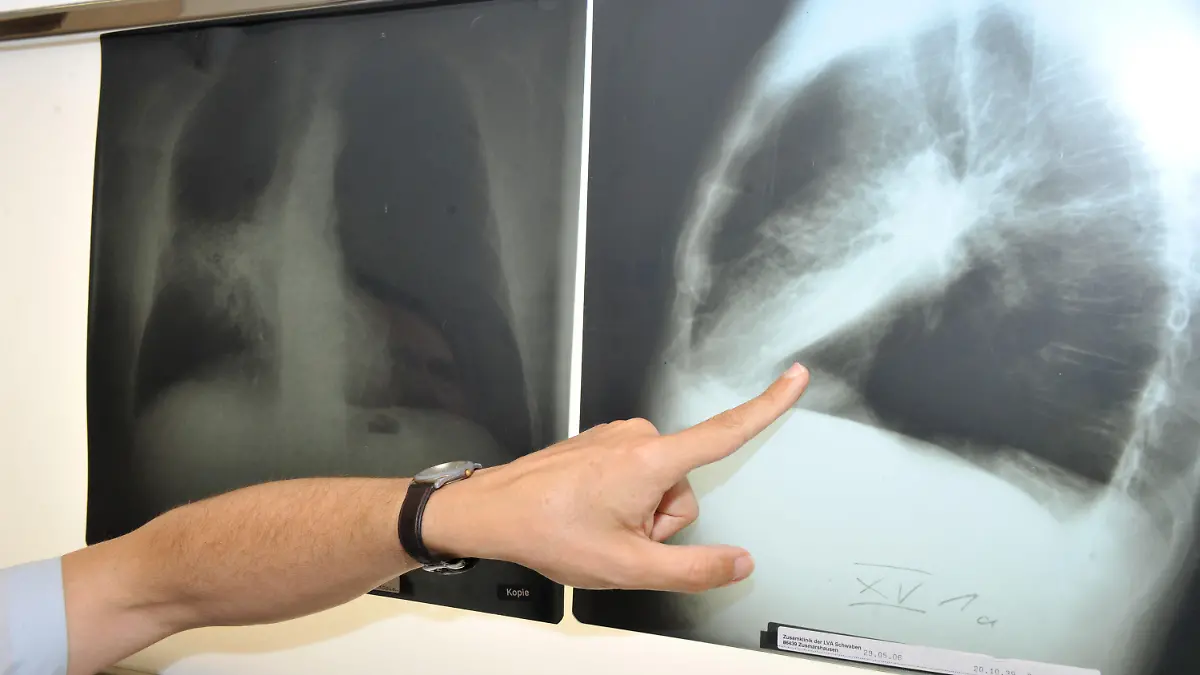 ARCHIV - 17.06.2010, Bayern, München: Der Leiter der Pneumologie (Lungenheilkunde) im Klinikum der Universität München zeigt auf ein Röntgenbild einer von Krebs befallenen Lunge. (zu dpa "Schätzung für Deutschland: Gut 240 000 Menschen sterben 2023 an Krebs") Foto: Felix Hörhager/dpa +++ dpa-Bildfunk +++