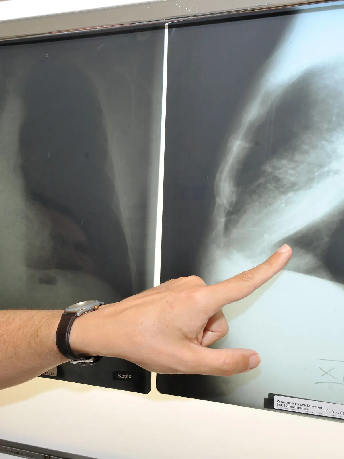ARCHIV - 17.06.2010, Bayern, München: Der Leiter der Pneumologie (Lungenheilkunde) im Klinikum der Universität München zeigt auf ein Röntgenbild einer von Krebs befallenen Lunge. (zu dpa "Schätzung für Deutschland: Gut 240 000 Menschen sterben 2023 an Krebs") Foto: Felix Hörhager/dpa +++ dpa-Bildfunk +++