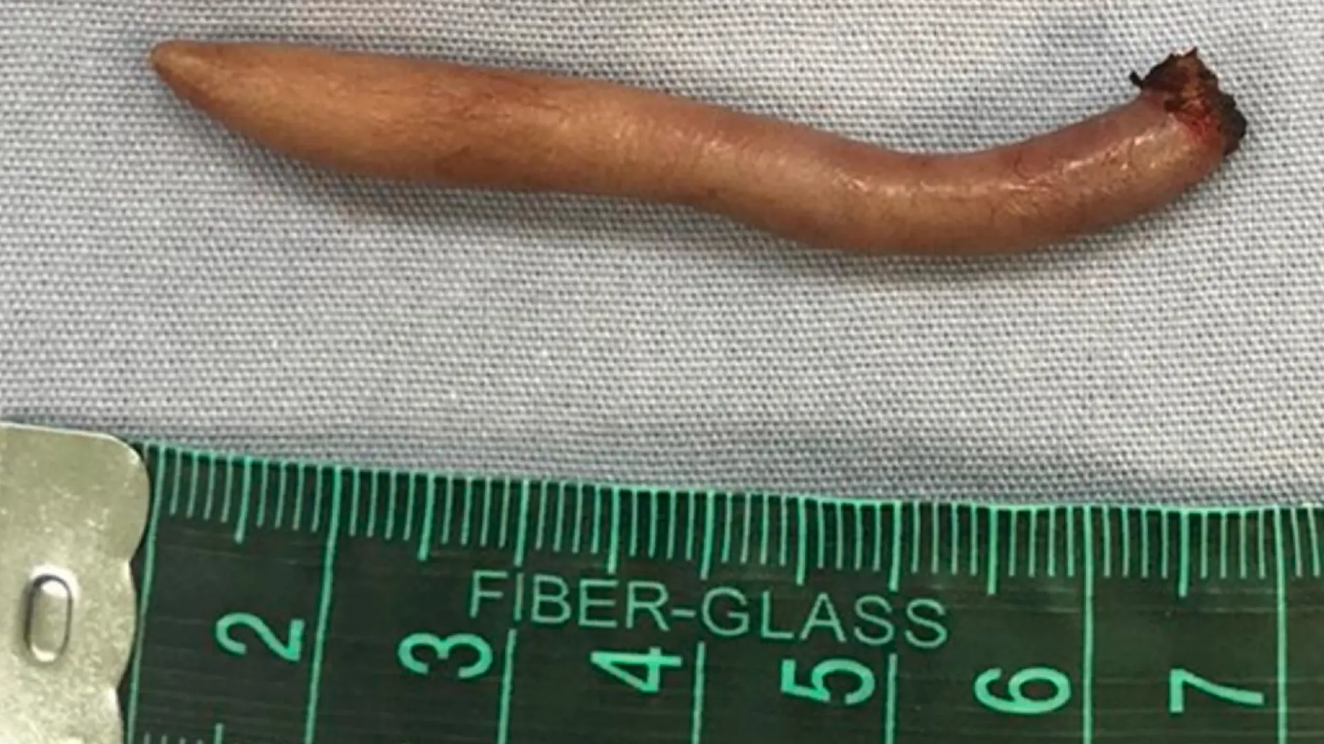 Story from Jam Press (Human Tail)
Pictured: The tail after its removal.
Baby girl born with 5cm GROWING TAIL ‘covered in hair and skin’ in extremely rare medical case
Doctors have successfully removed a “true tail” from a newborn baby girl – and the condition is thought to be incredibly rare.
The infant was born via caesarean delivery at a rural hospital in north-eastern Mexico.
According to the case study entry in the Journal of Paediatric Surgery, “the child had no previous history of radiation, teratogen exposure, or infections during pregnancy,” and she was born to “two healthy parents” in their late twenties.
The tail-like structure was measured at 5.7 cm in length, with a diameter between 3 mm and 5 mm in all its length, it was also cylindrical and was pointed towards the end.
Doctors noted the tail was covered with hair and skin and the baby cried when the structure was pinched by a needle.
Medical professionals then performed a Lumbosacral X-ray but found no evidence of anomalies or bone structures inside the tail, meaning the tail was not a vestigial tail but a “true tail” – an extremely rare occurrence.
Doctors established there were no heart or hearing problems, urinary tract malformations, or vesicoureteral reflux.
Her MRI also revealed no cerebral anomalies, and was negative for posterior dysraphism, with the spinal cord and spinal cone of normal characteristics.
Once doctors ruled out spinal dysraphism the young patient was re-assessed by a paediatrics and general surgery team at two months of age.
Satisfied there had been adequate weight gain and growth for age, the tail structure had increased 0.8 cm in length.
With no evidence of skin lesions a decision was made to remove the tail and reconstruct the area by Limberg plasty.
The patient was discharged and no complications have been reported since.
According to the journal: “The presence of tails in humans is extremely infrequent. In the most recent review by