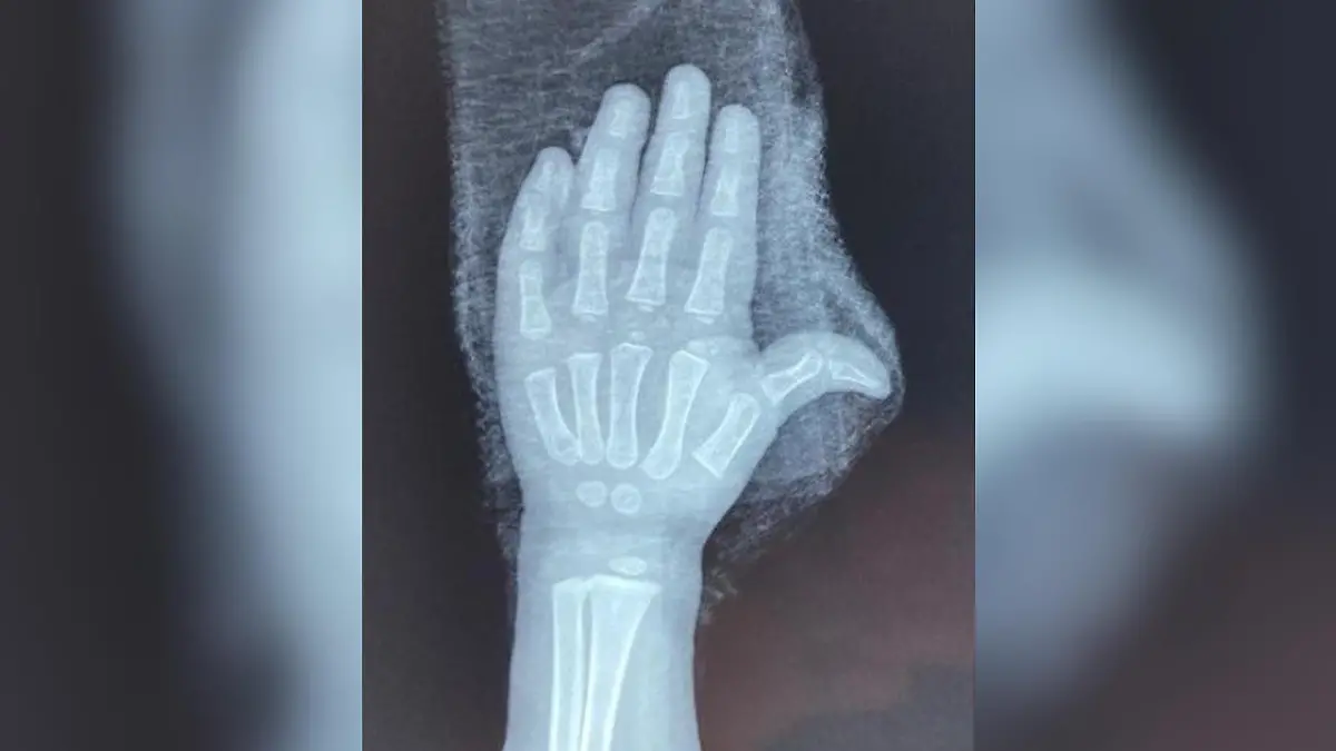 Ärzte konnten die Hand des Mädchens schließlich retten.