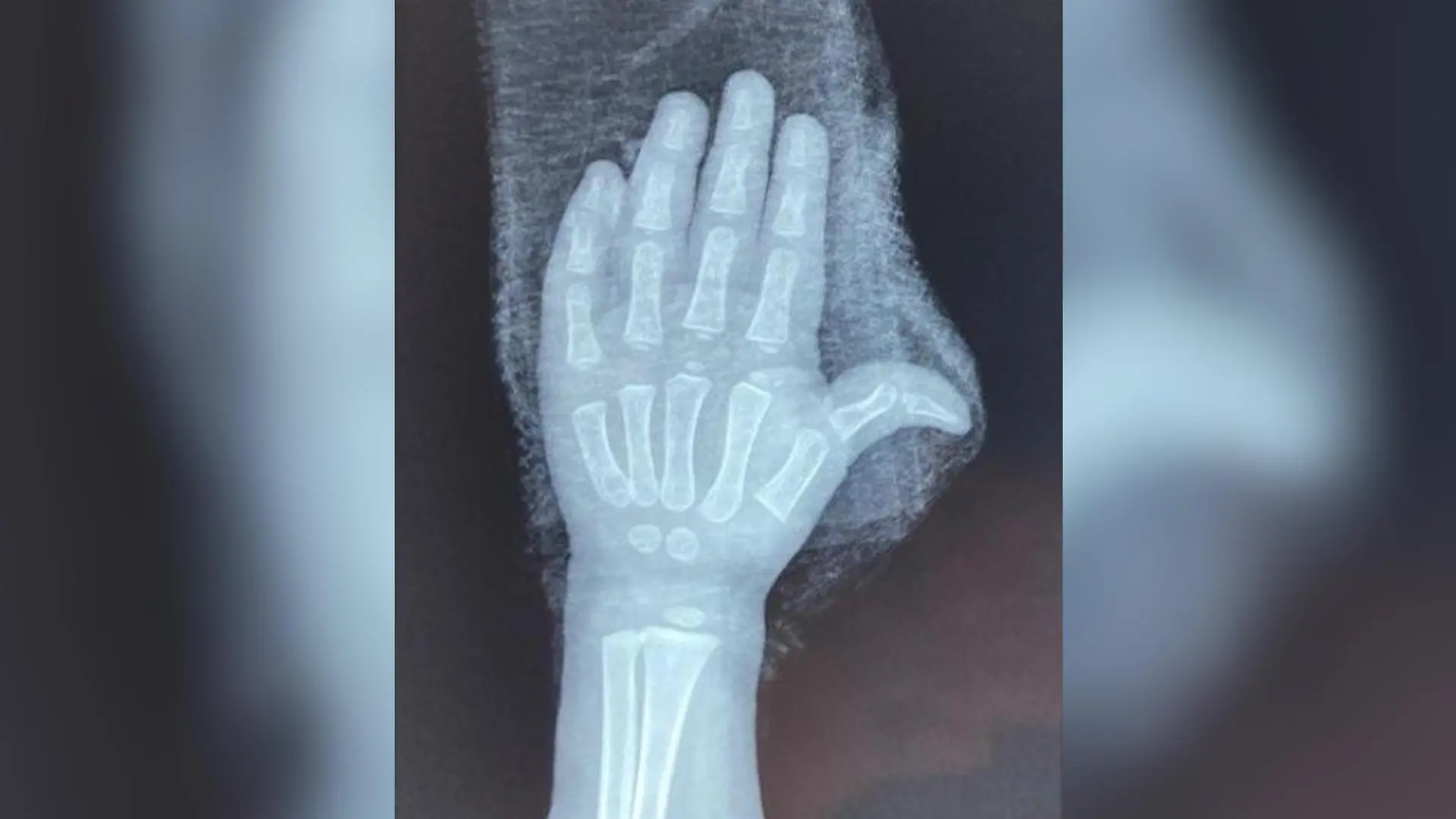 Ärzte konnten die Hand des Mädchens schließlich retten.