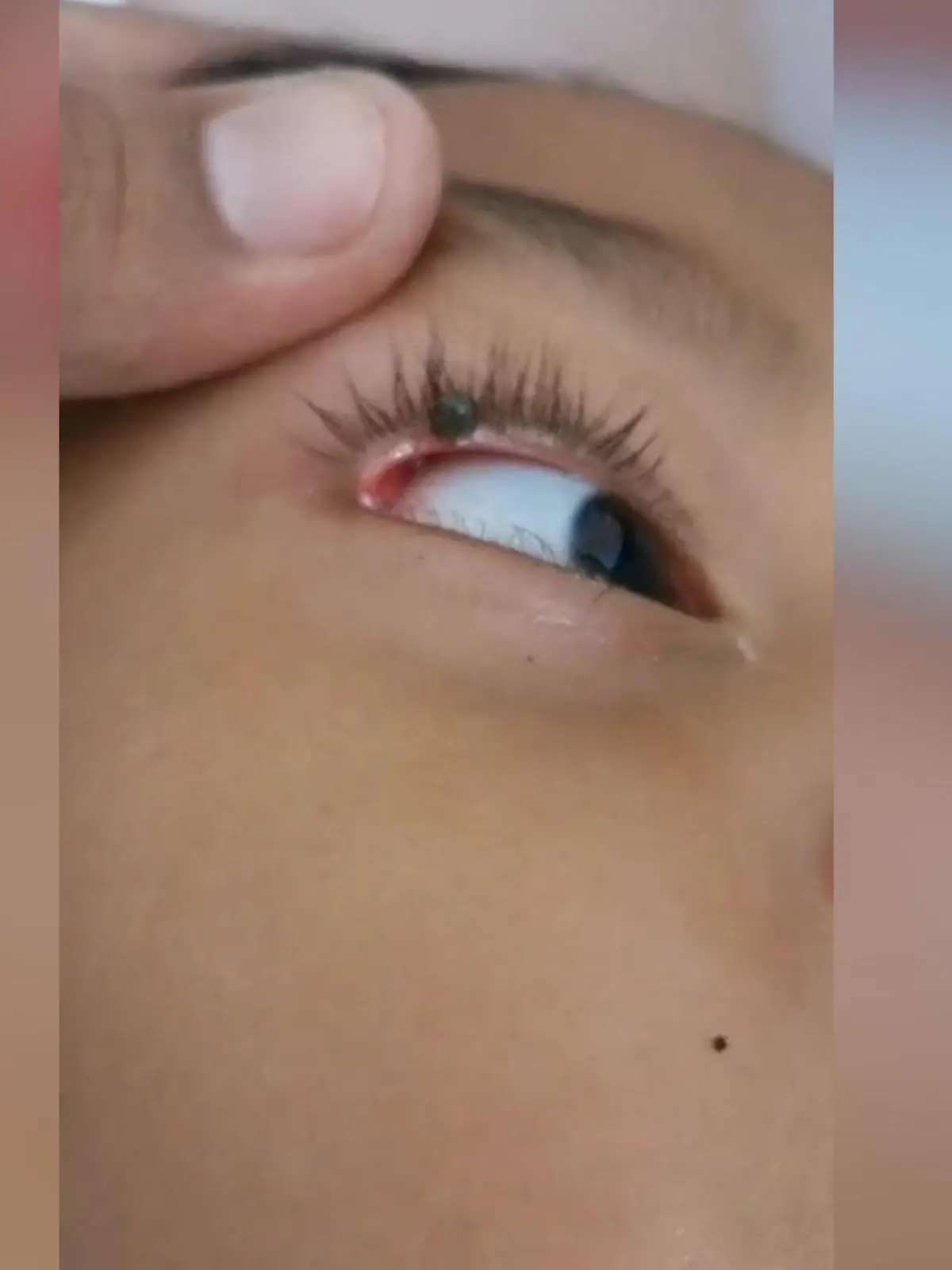 Die schnelle Auffassungsgabe und die ruhige Hand eines Vaters retteten in Malaysia den Tag, als er eine riesige Zecke entdeckte, die fest auf dem Augenlid seines Sohnes saß.