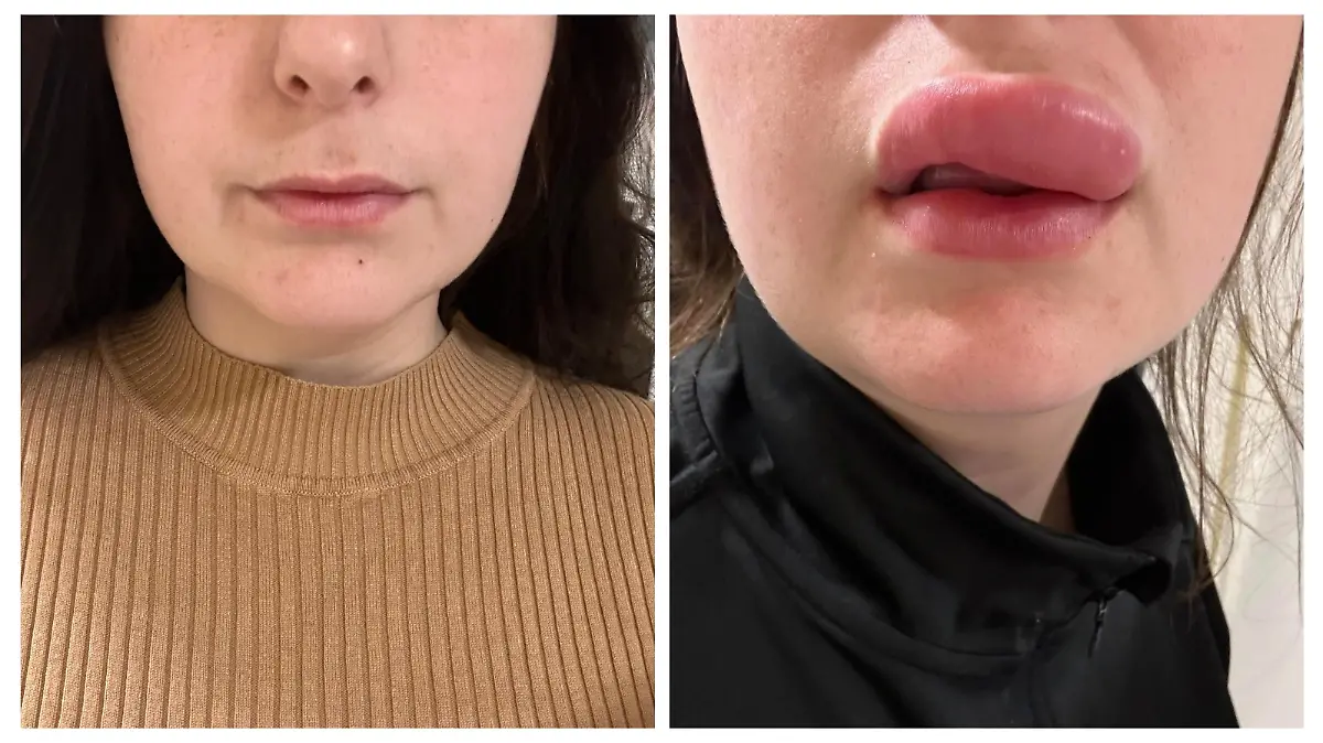 Lippenfiller-Behandlung geht schief