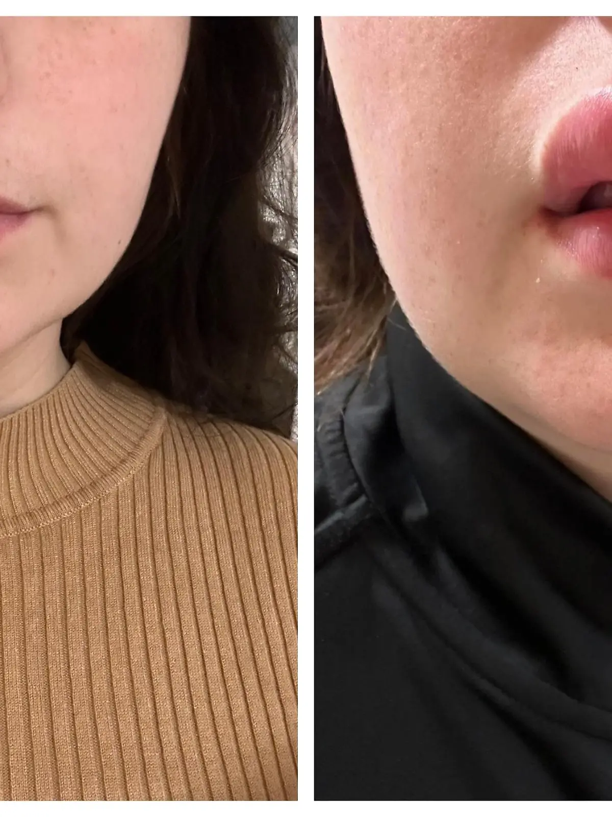 Lippenfiller-Behandlung geht schief
