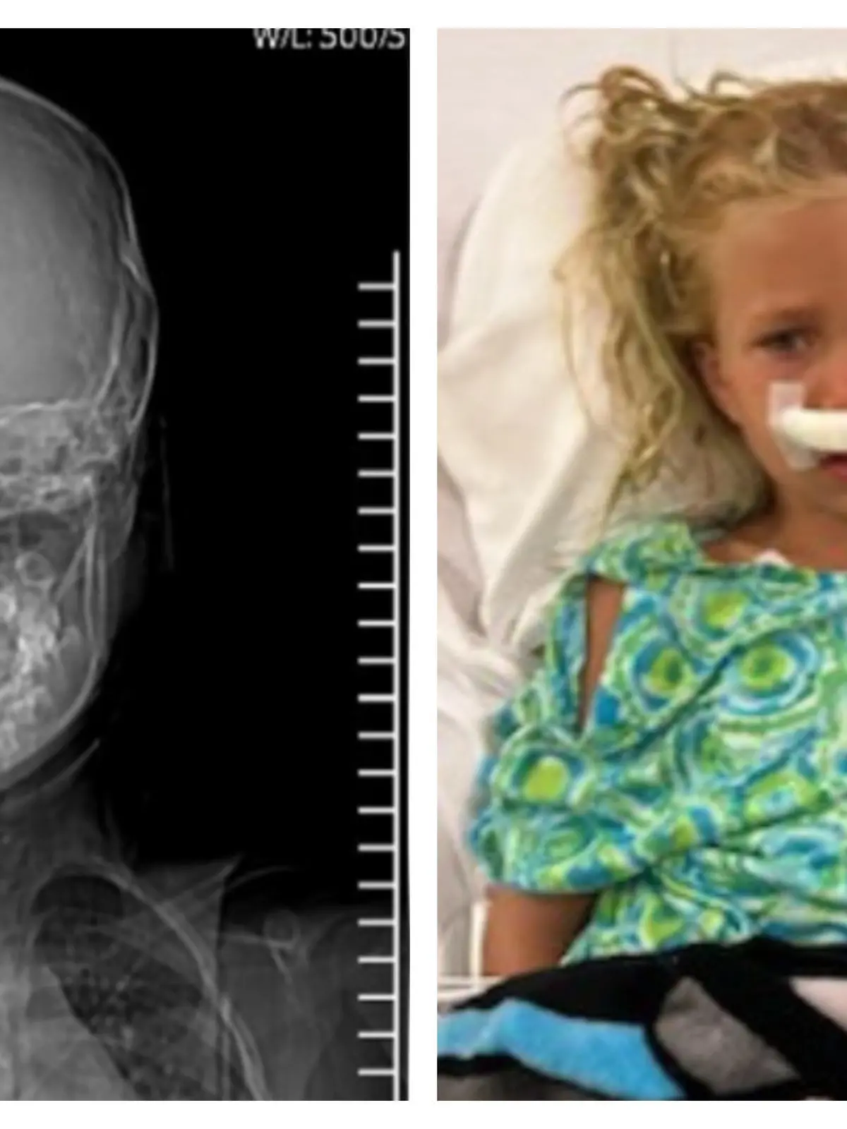 Collage Röntgenaufnahme mit Pfeil / Olivia im Krankenhaus