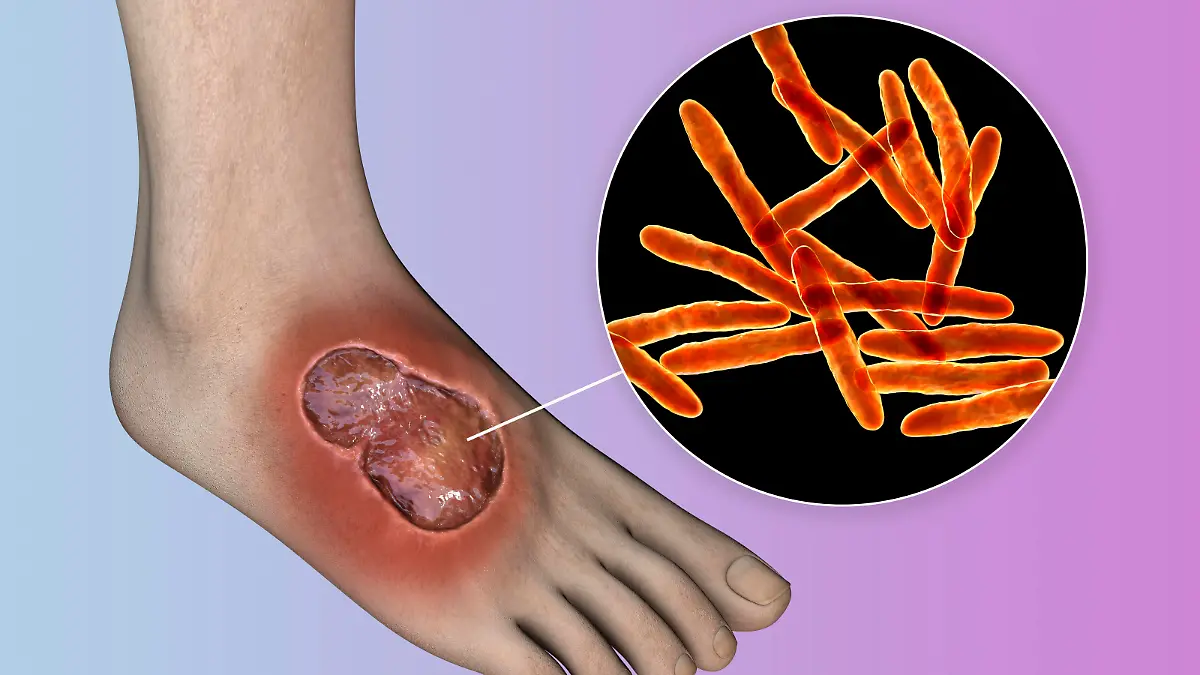 RECORD DATE NOT STATED Buruli ulcer and Mycobacterium ulcerans, illustration Illustration of a buruli ulcer on a foot with a close-up view of Mycobacterium ulcerans, the bacterium that causes the disease. *** Buruli ulcer and Mycobacterium ulcerans, illustration Illustration of a buruli ulcer on a foot with a close up view of Mycobacterium ulcerans, the bacterium that causes the disease PUBLICATIONxINxGERxSUIxHUNxONLY KATERYNAxKON/SCIENCExPHOTOxLIBRARY F037/5210
