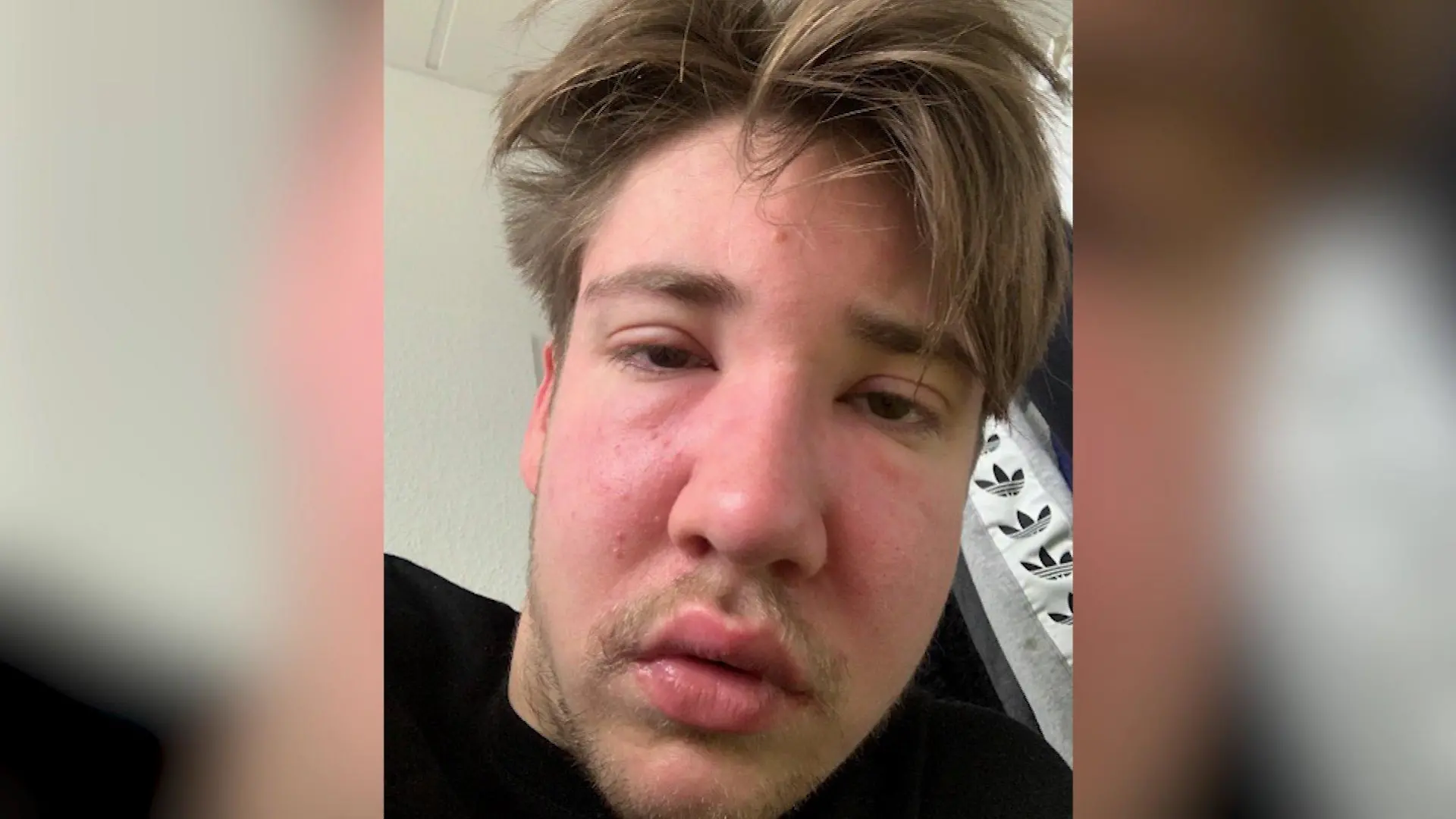 Henry-Bijan Hansen mit Schwellung im Gesicht