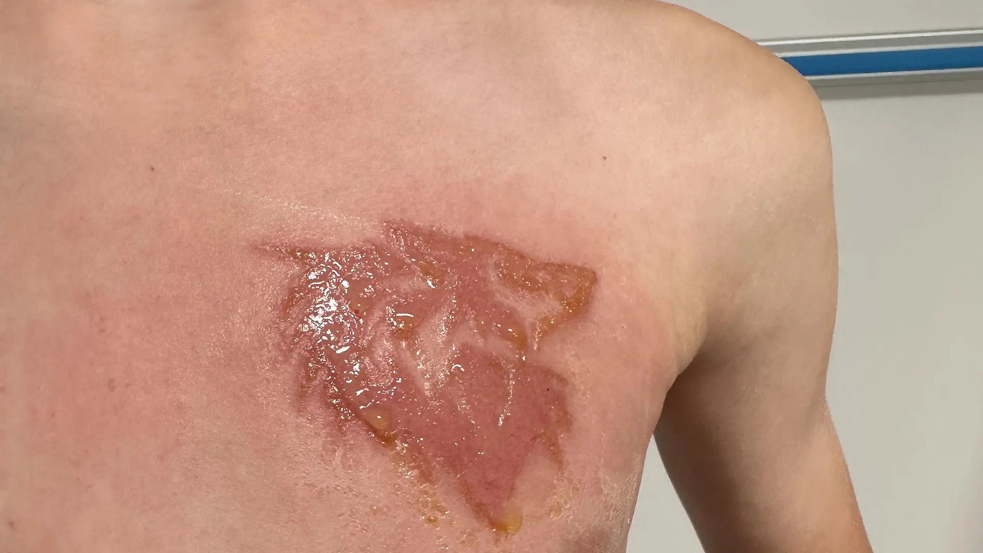 PIC FROM Kennedy News and Media (Pictured:OLLIE SHAKESHEFF'S SCAR FROM THE BLACK HENNA.) A mum claims her nine-year-old son's bit of 'holiday fun' henna tattoo has left him 'scarred for life' - after it hospitalised him with chemical burns. Monika Shakesheff from Bridgetown in Stratford-upon-Avon, let her two sons, Ollie Shakesheff, nine, and seven-year-old Charlie Shakesheff, get the temporary inkings done while on holiday in a Tui-managed hotel in Turkey last month. Ollie chose a 10cm wolf inking that he had drawn on the left side of his chest while Charlie plumped for a 10cm outline of footy legend Ronaldo traced onto his left leg. DISCLAIMER: While Kennedy News and Media uses its best endeavours to establish the copyright and authenticity of all pictures supplied, it accepts no liability for any damage, loss or legal action caused by the use of images supplied and the publication of images is solely at your discretion. SEE KENNEDY NEWS COPY - 0161 697 4266

