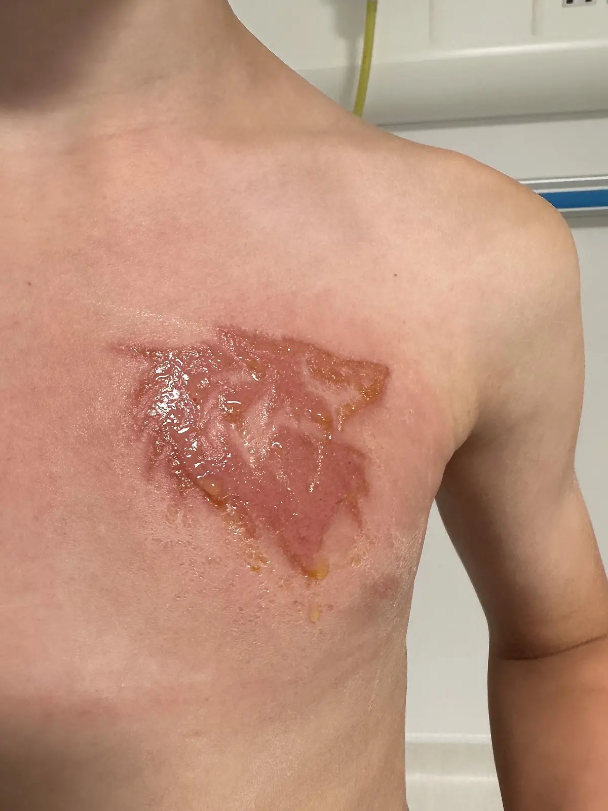 PIC FROM Kennedy News and Media (Pictured:OLLIE SHAKESHEFF'S SCAR FROM THE BLACK HENNA.) A mum claims her nine-year-old son's bit of 'holiday fun' henna tattoo has left him 'scarred for life' - after it hospitalised him with chemical burns. Monika Shakesheff from Bridgetown in Stratford-upon-Avon, let her two sons, Ollie Shakesheff, nine, and seven-year-old Charlie Shakesheff, get the temporary inkings done while on holiday in a Tui-managed hotel in Turkey last month. Ollie chose a 10cm wolf inking that he had drawn on the left side of his chest while Charlie plumped for a 10cm outline of footy legend Ronaldo traced onto his left leg. DISCLAIMER: While Kennedy News and Media uses its best endeavours to establish the copyright and authenticity of all pictures supplied, it accepts no liability for any damage, loss or legal action caused by the use of images supplied and the publication of images is solely at your discretion. SEE KENNEDY NEWS COPY - 0161 697 4266


