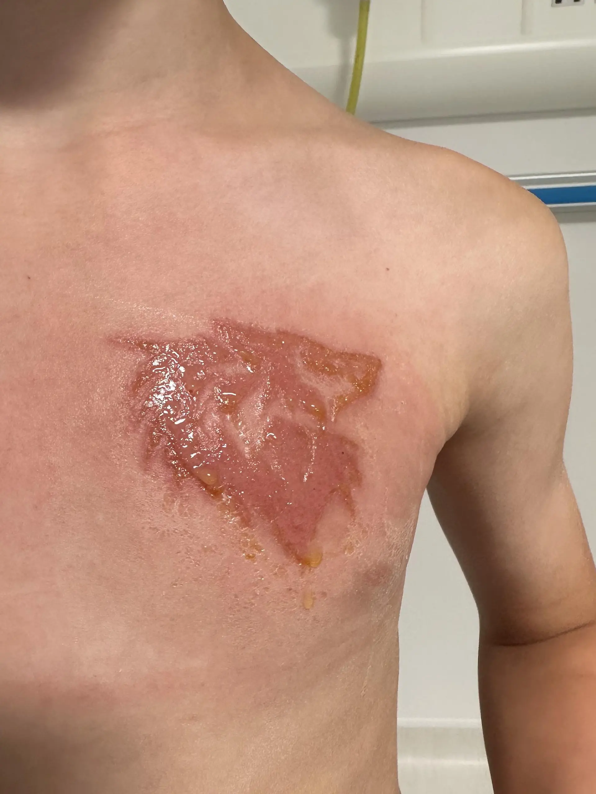 PIC FROM Kennedy News and Media (Pictured:OLLIE SHAKESHEFF'S SCAR FROM THE BLACK HENNA.) A mum claims her nine-year-old son's bit of 'holiday fun' henna tattoo has left him 'scarred for life' - after it hospitalised him with chemical burns. Monika Shakesheff from Bridgetown in Stratford-upon-Avon, let her two sons, Ollie Shakesheff, nine, and seven-year-old Charlie Shakesheff, get the temporary inkings done while on holiday in a Tui-managed hotel in Turkey last month. Ollie chose a 10cm wolf inking that he had drawn on the left side of his chest while Charlie plumped for a 10cm outline of footy legend Ronaldo traced onto his left leg. DISCLAIMER: While Kennedy News and Media uses its best endeavours to establish the copyright and authenticity of all pictures supplied, it accepts no liability for any damage, loss or legal action caused by the use of images supplied and the publication of images is solely at your discretion. SEE KENNEDY NEWS COPY - 0161 697 4266

